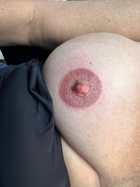 after areola procedure