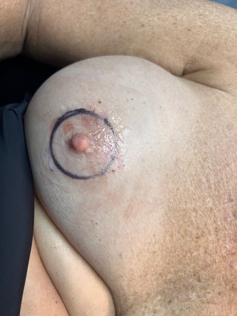  before areola procedure