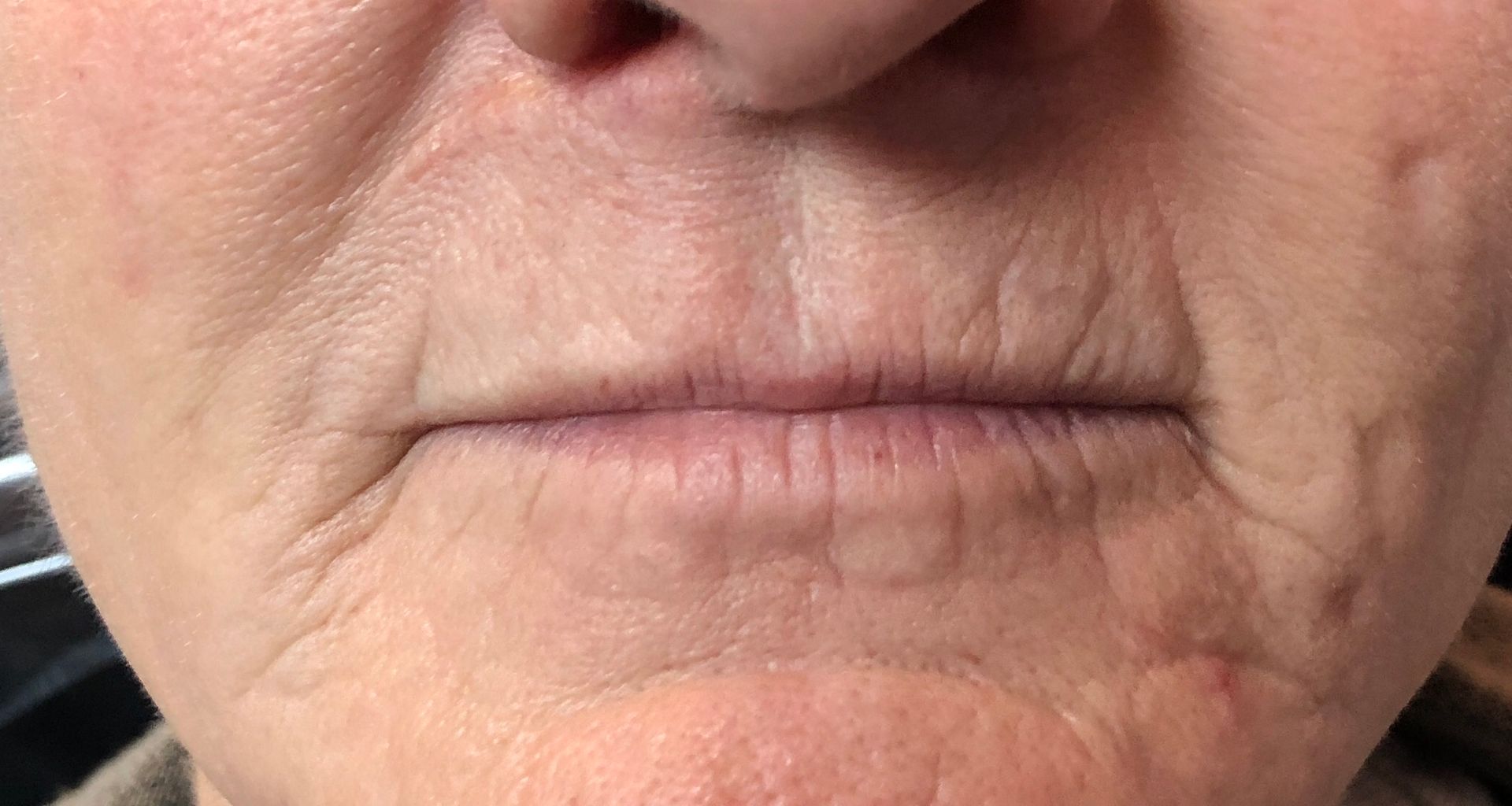 lips before procedure