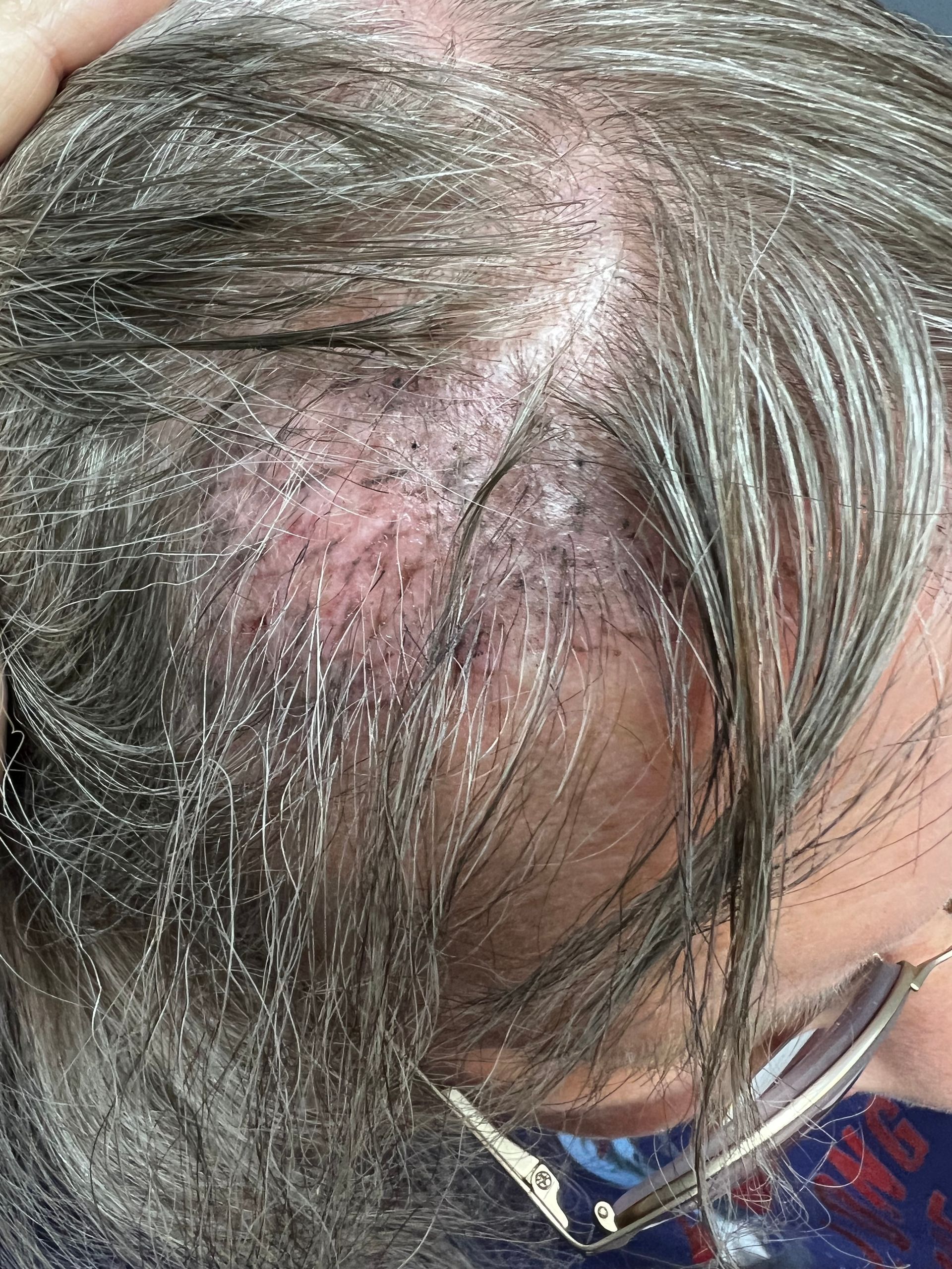 after hair stimulation