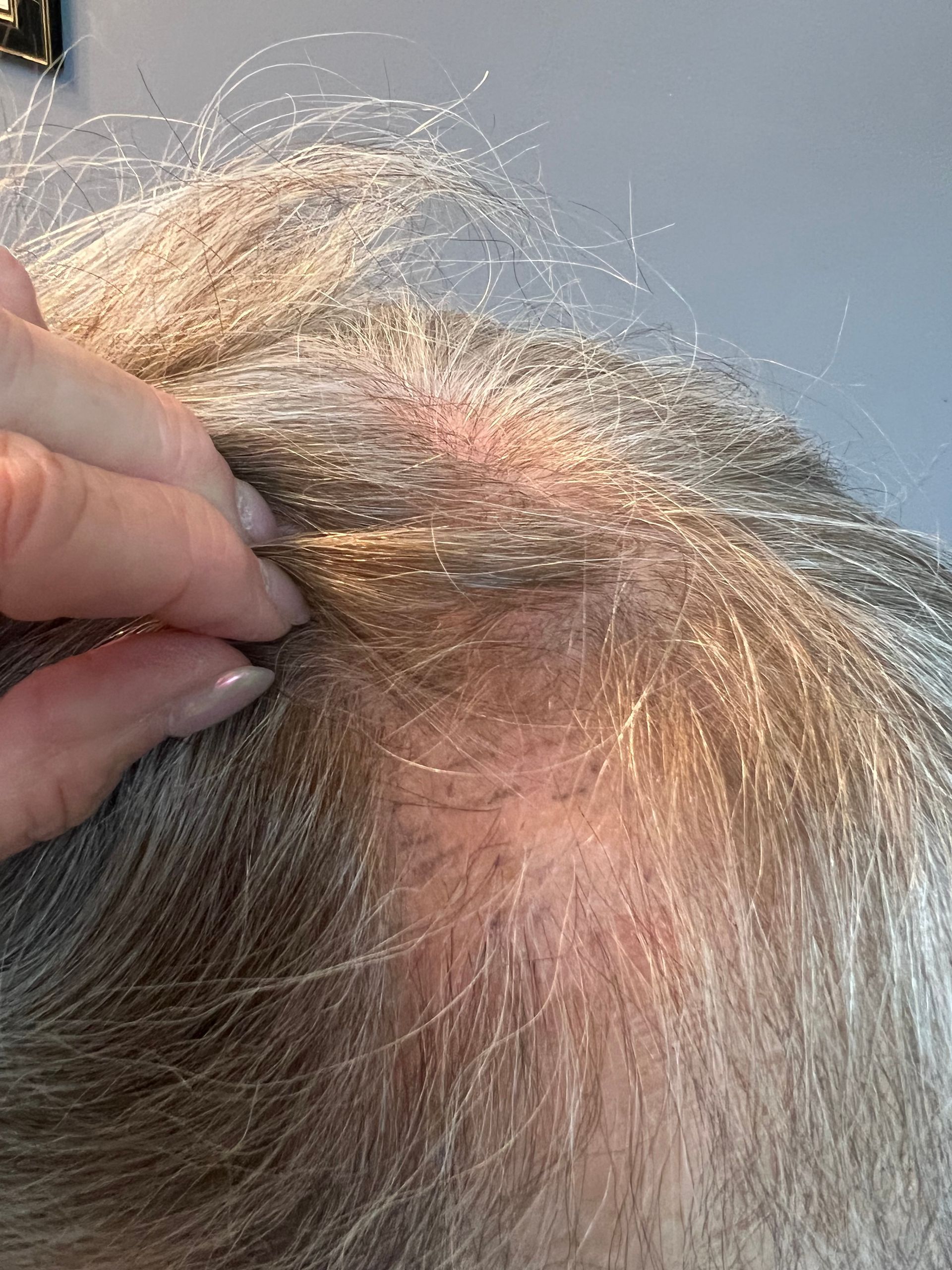 Hair simulation before procedure