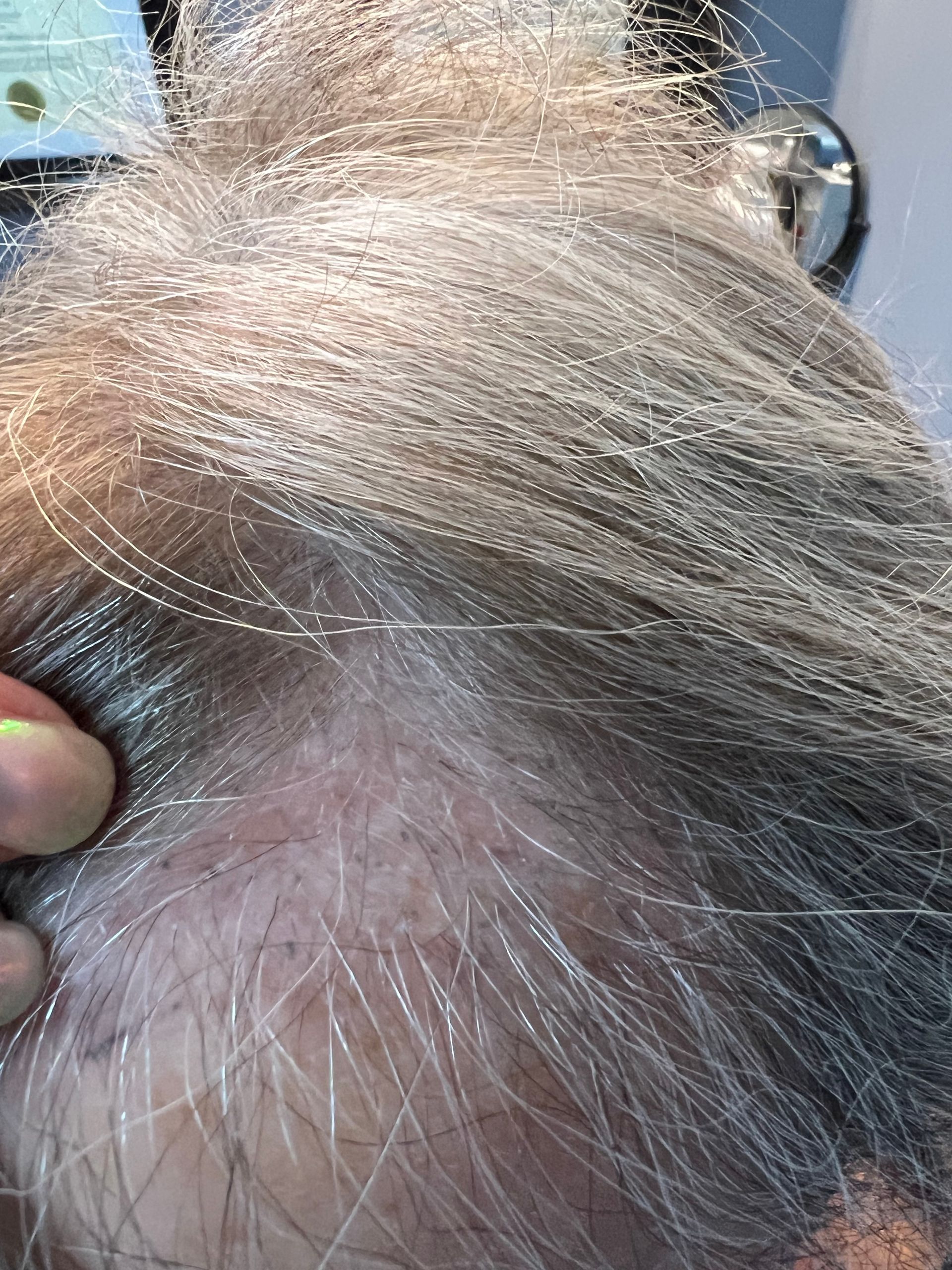  Hair simuafter procedure