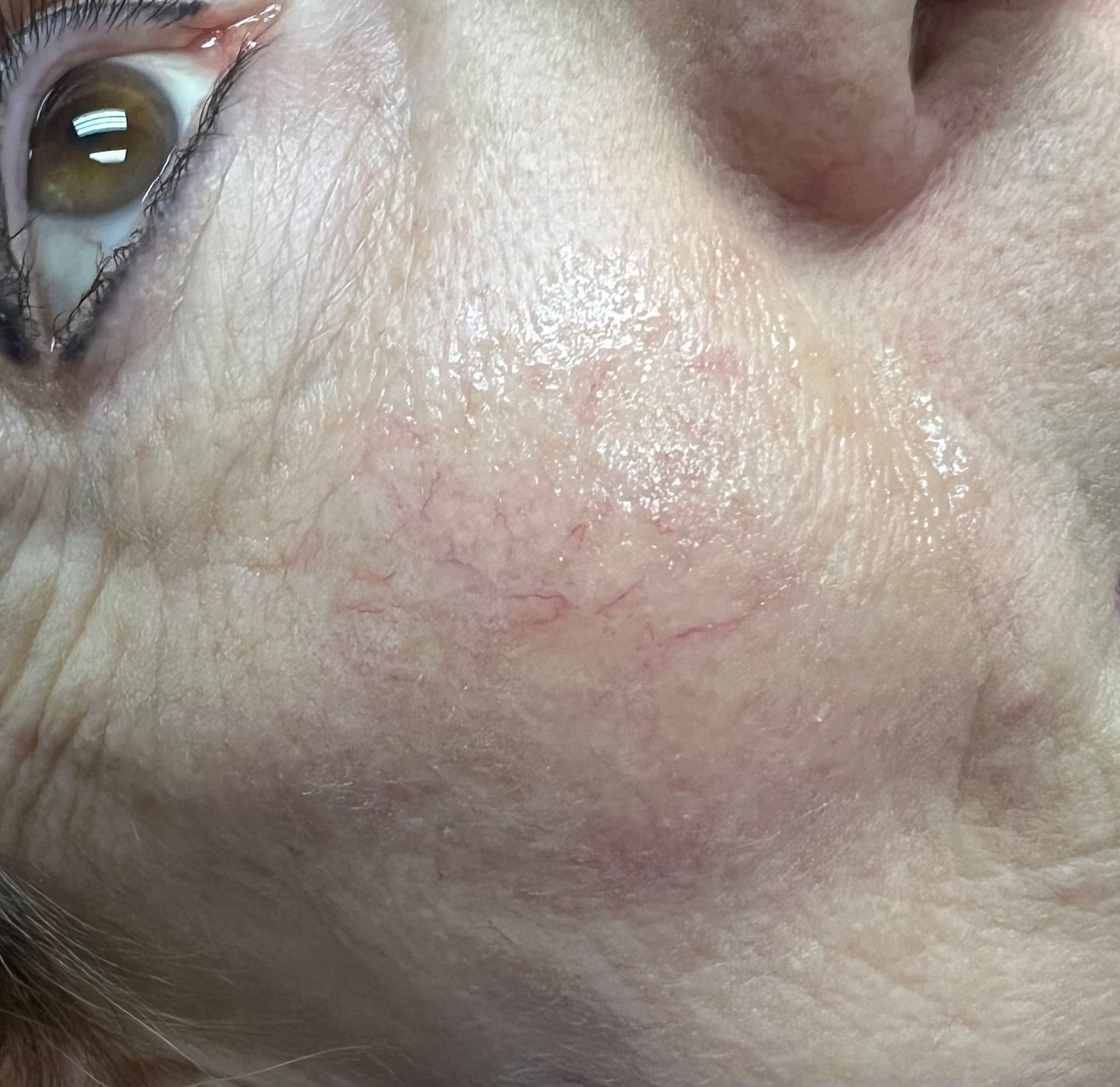  before vein reduction