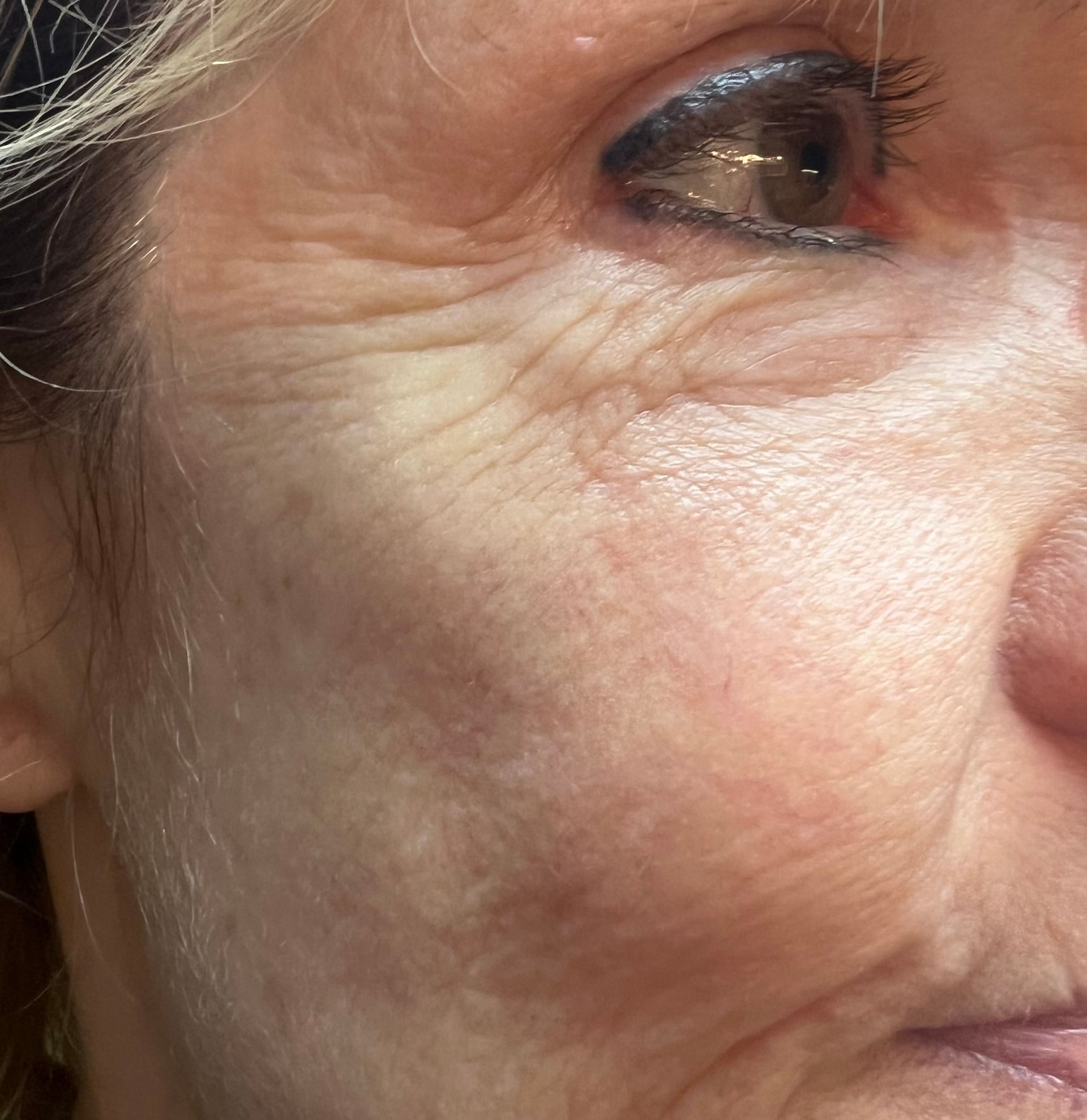 after vein reduction