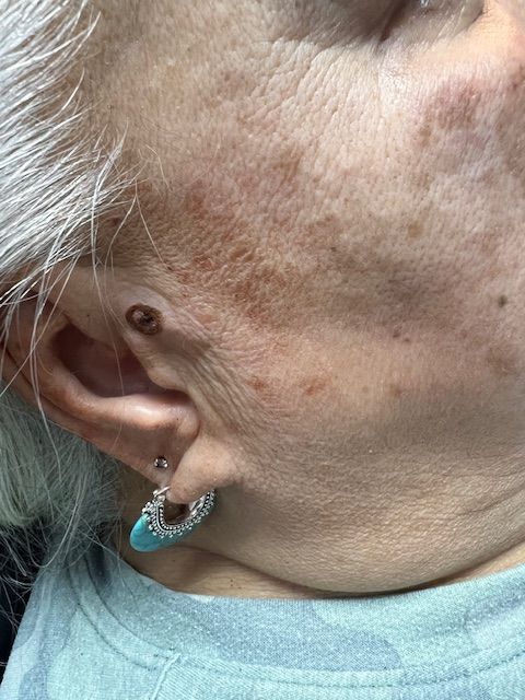 after skin tag removal