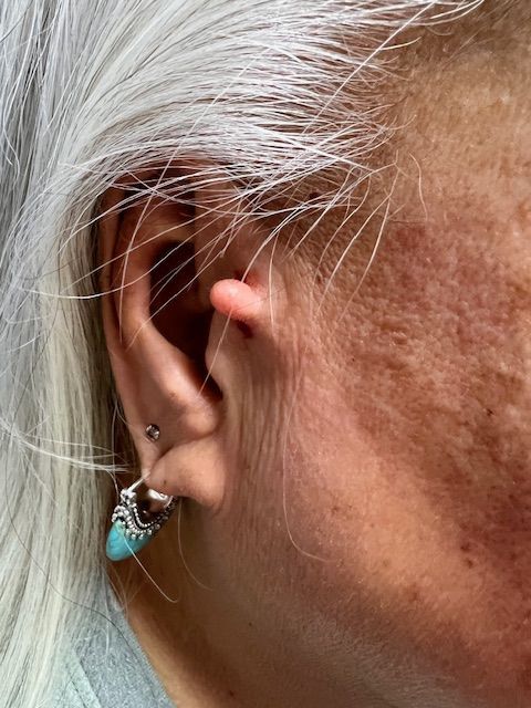  before skin tag removal