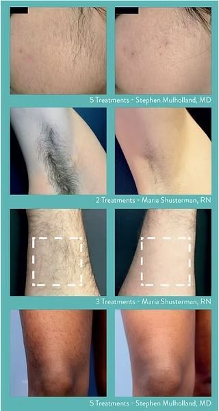 Before and after laser hair removal on armpits and legs, showing reduced hair growth after treatment.