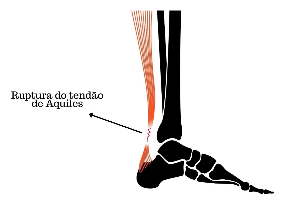 uptura-tendao-aquiles-dr-ivan-giarola-ortopedista-tornozelo-sao-paulo