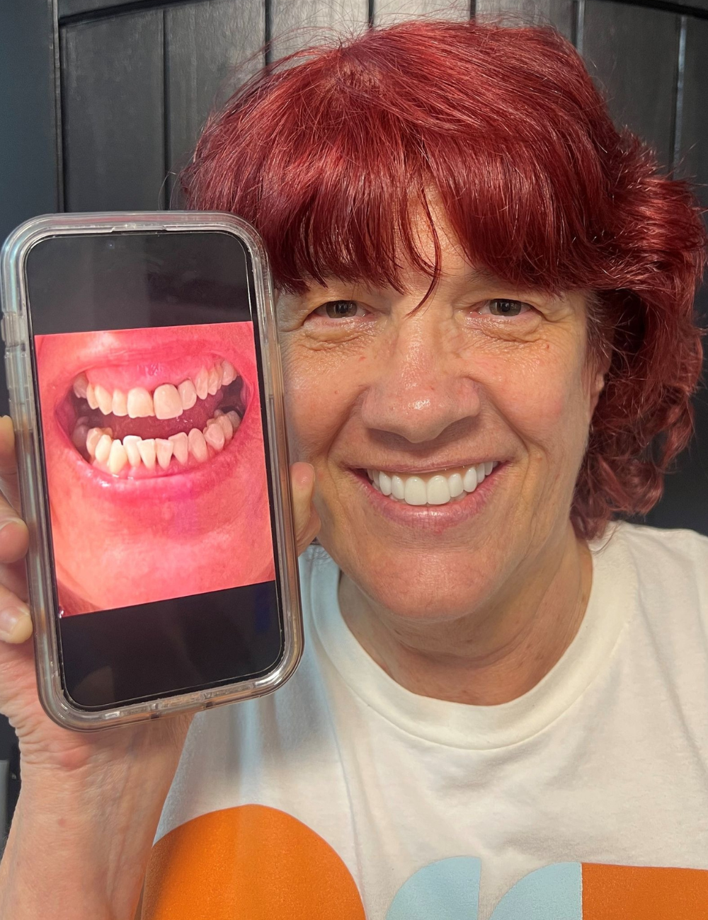 Woman smiling, holding phone showing close-up of teeth. She has red hair and is wearing a white t-shirt.