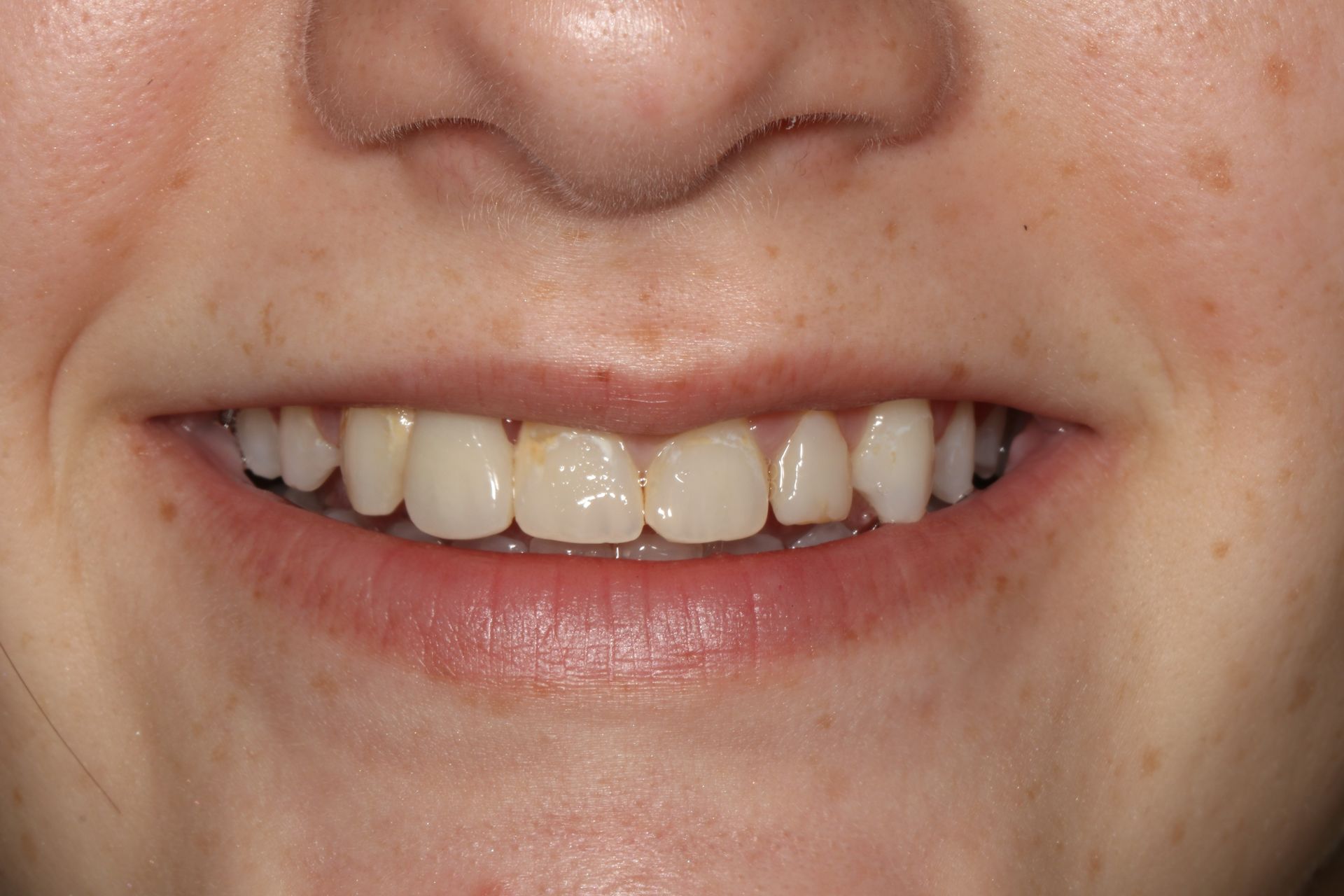 A close up of a woman 's smile with white teeth.