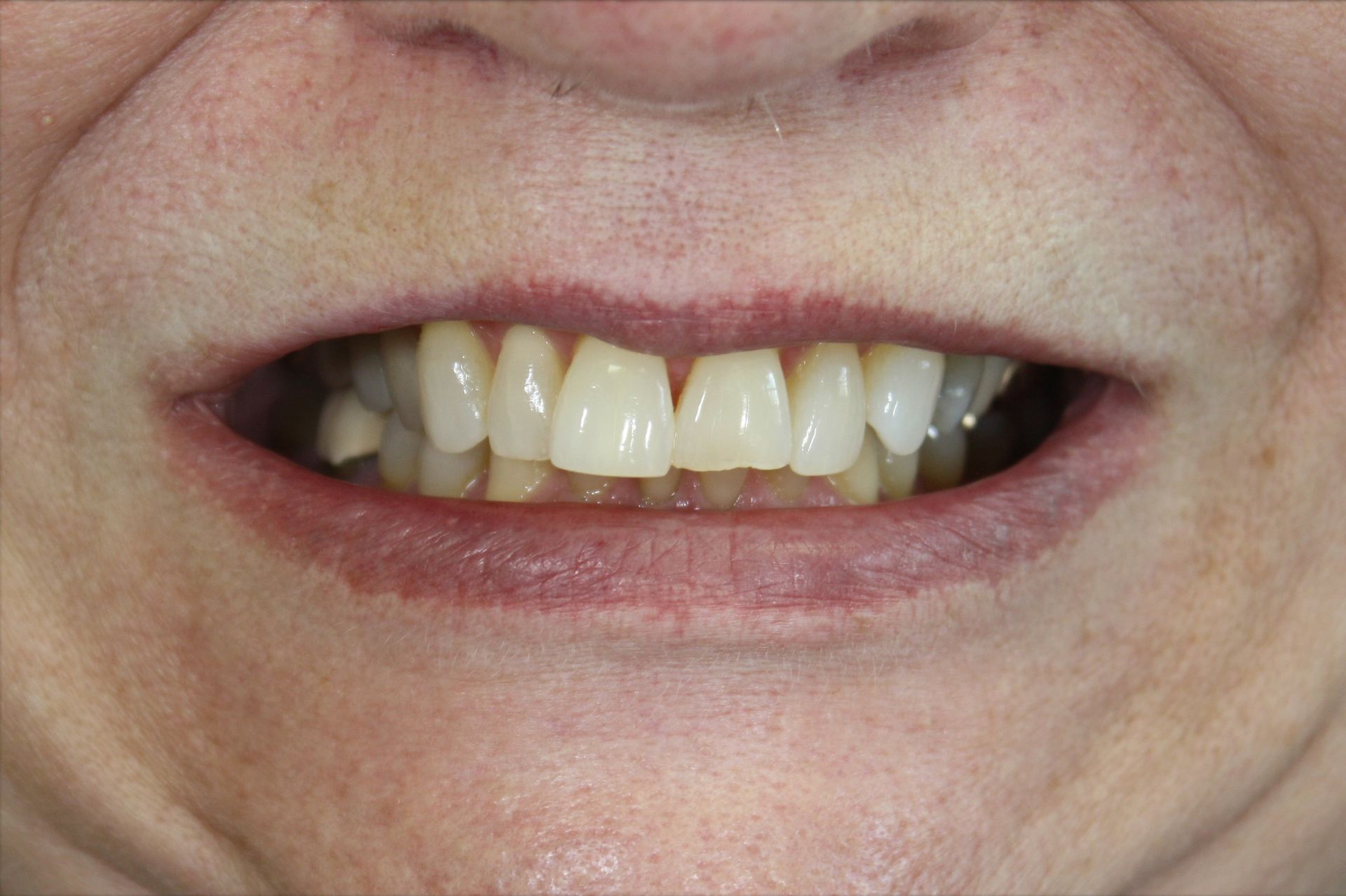 A close up of a woman 's mouth with white teeth.
