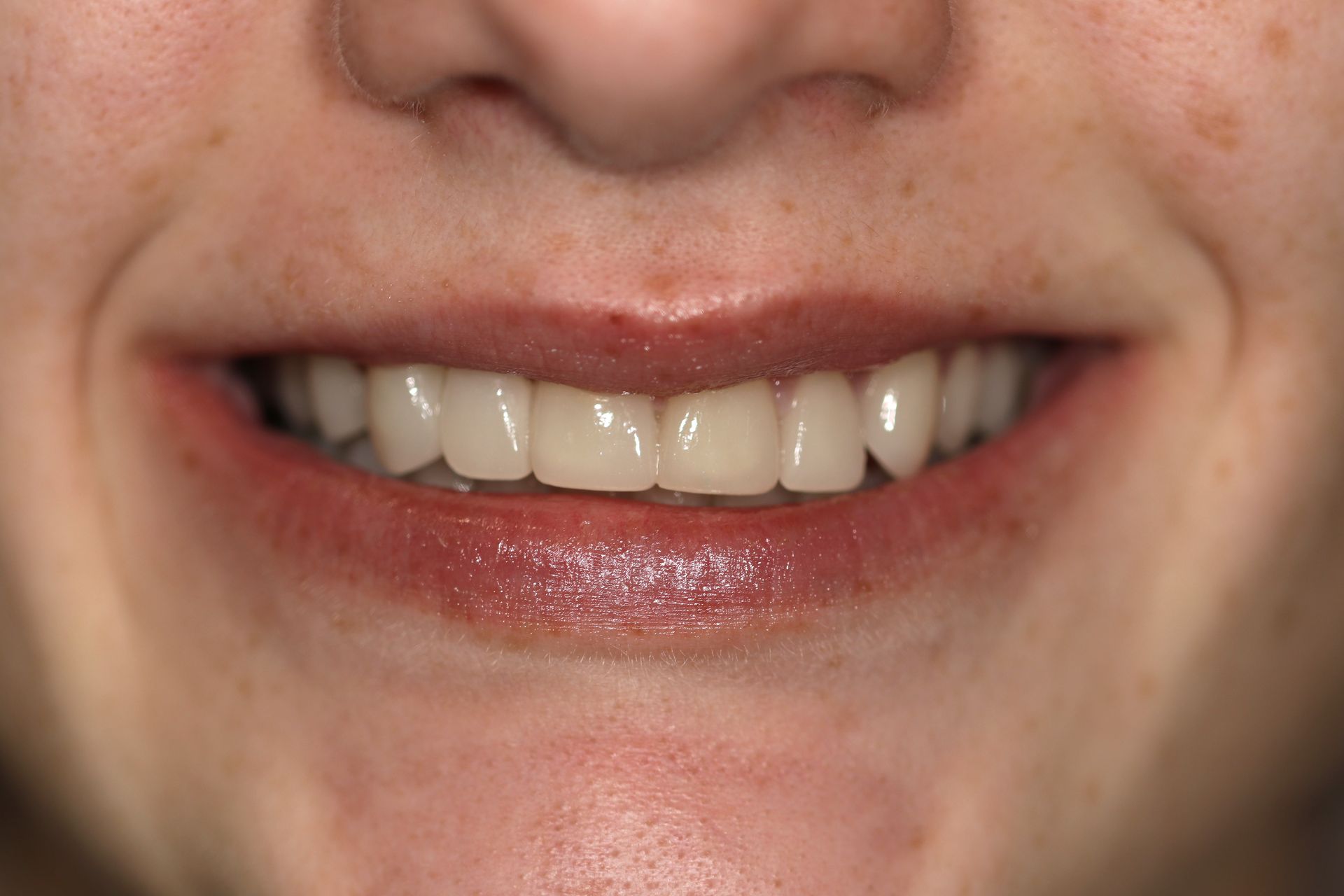 A close up of a woman 's smile with white teeth.