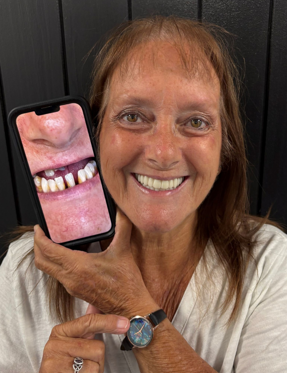 Woman smiles, holding phone showing old teeth; points to watch on wrist.