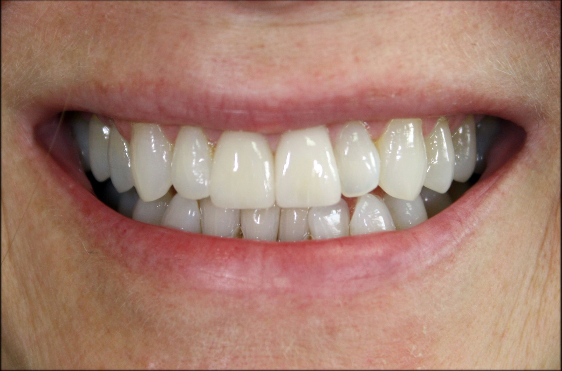 A close up of a person 's smile with white teeth