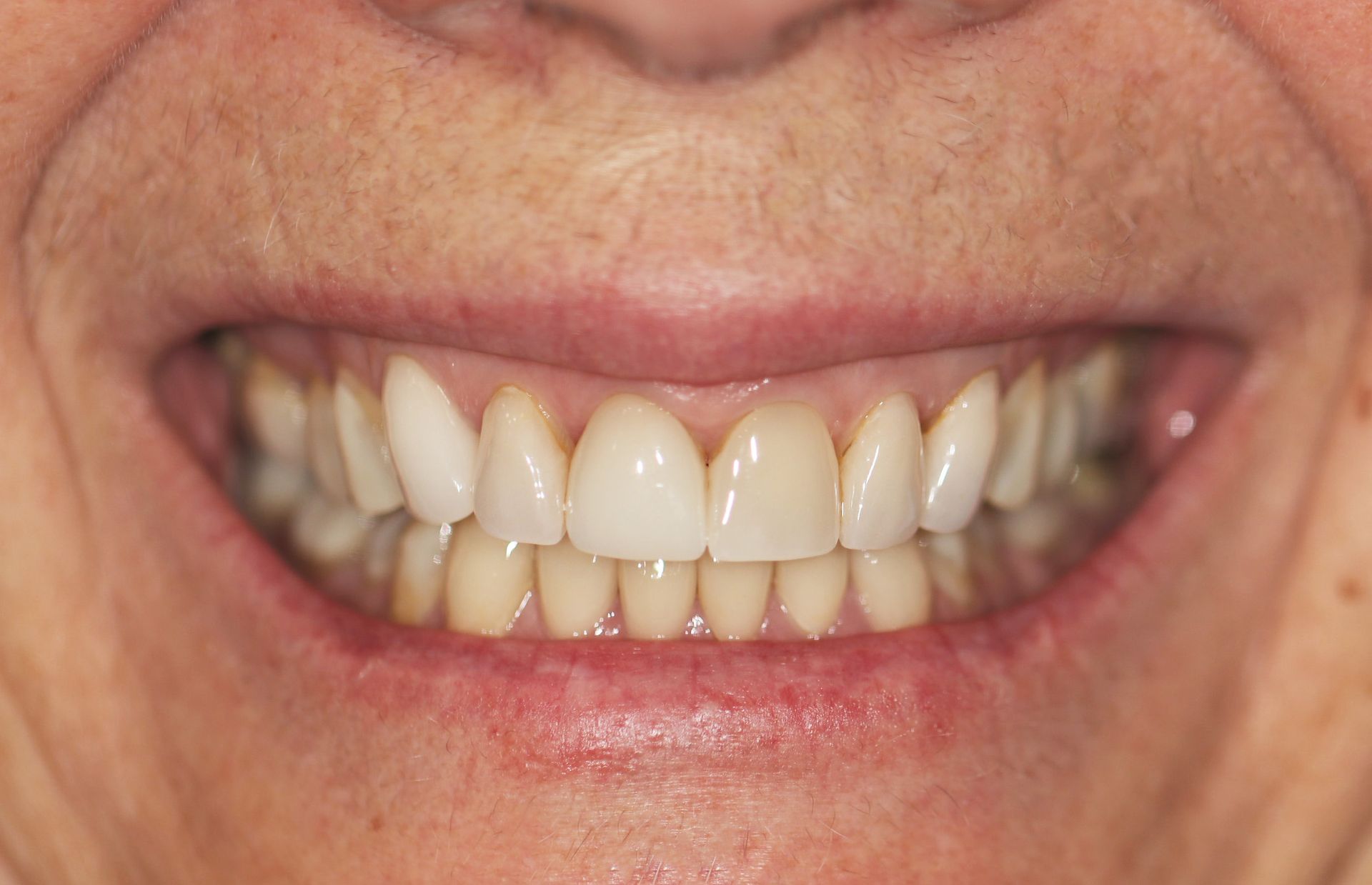 A close up of a woman 's smile with white teeth.