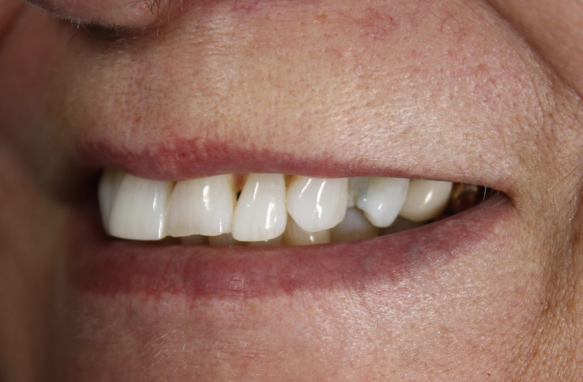 A close up of a woman 's smile with a broken tooth.