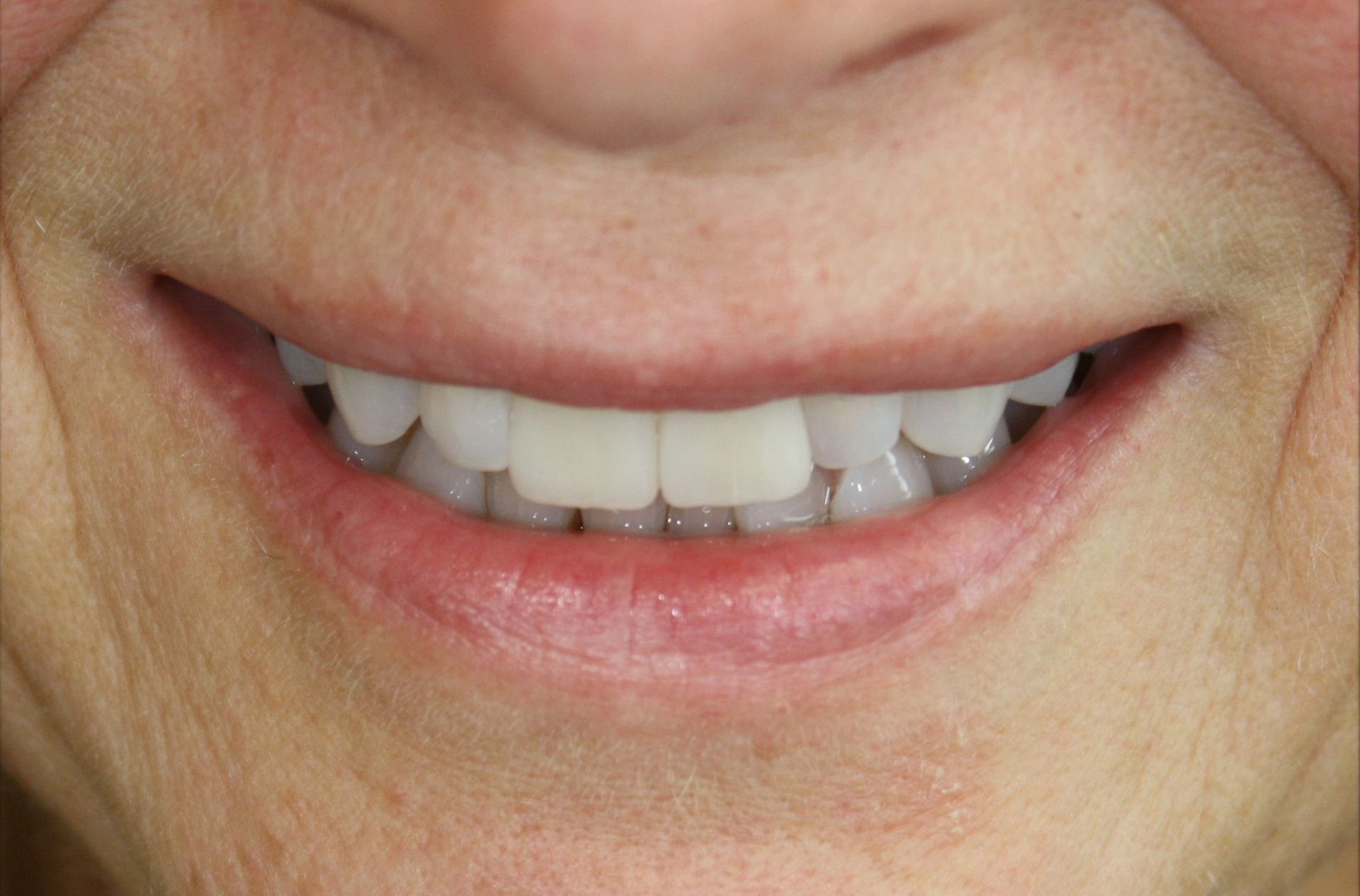 A close up of a woman 's smile with white teeth.