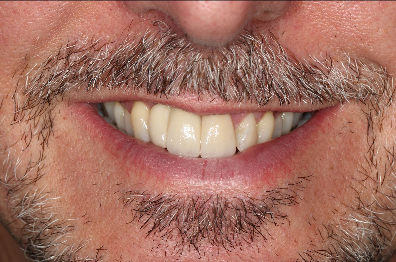 A close up of a man 's mouth with a beard and white teeth.