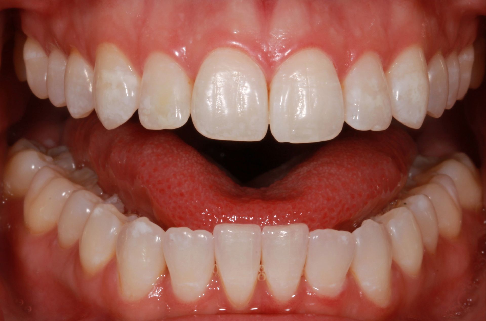 A close up of a person 's teeth with white teeth.