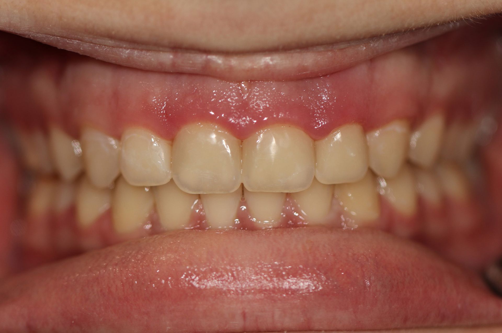 A close up of a person 's teeth and gums.