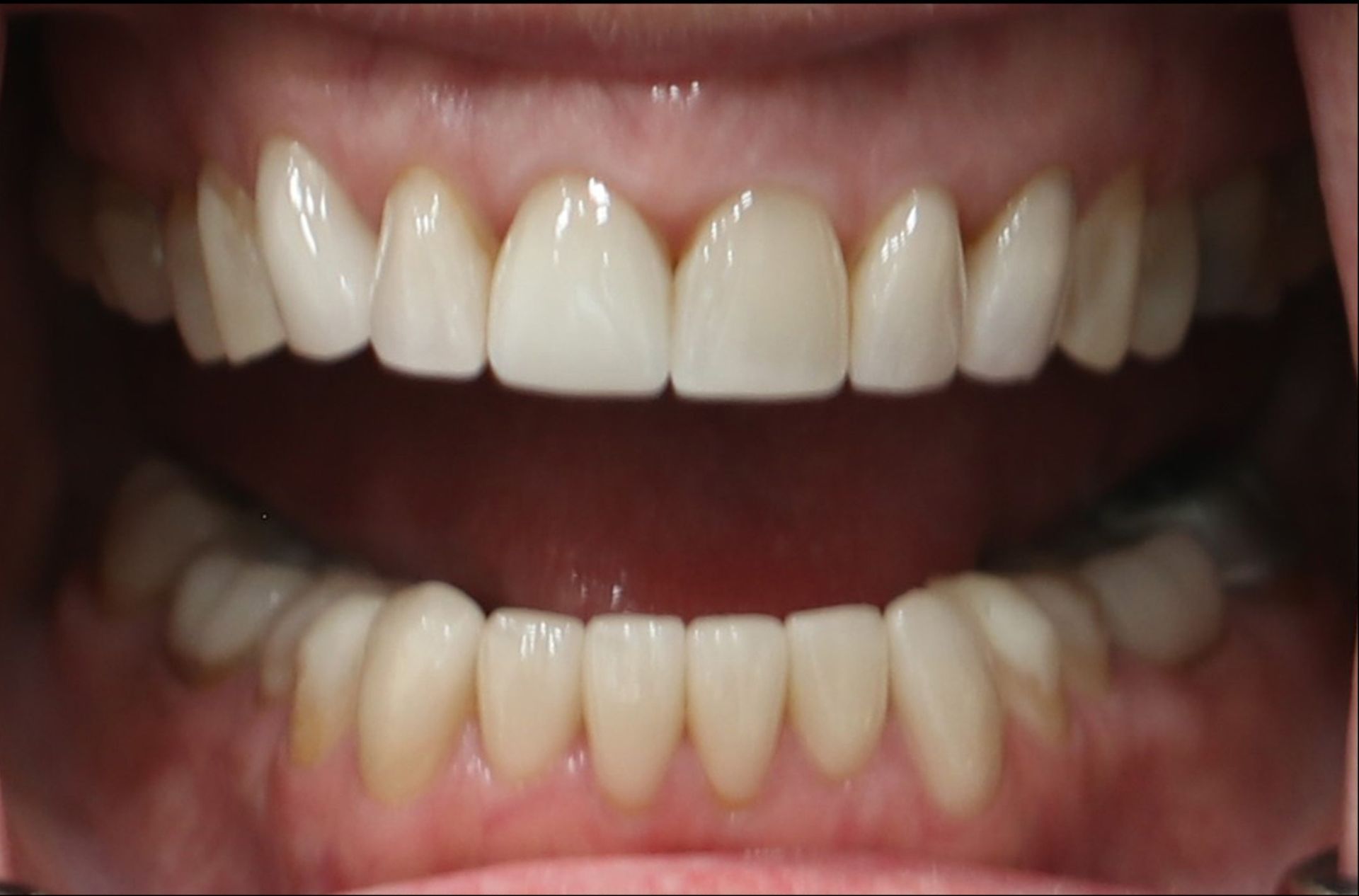 A close up of a person 's teeth with white teeth
