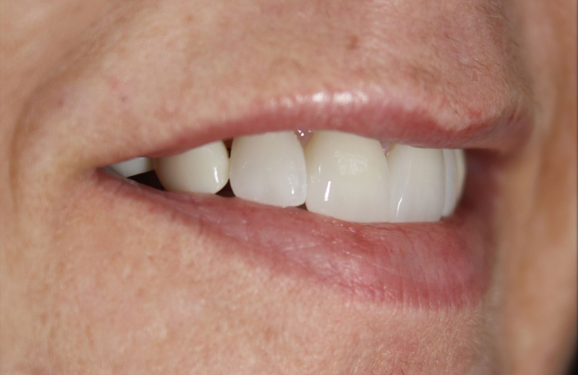 A close up of a woman 's mouth with white teeth.