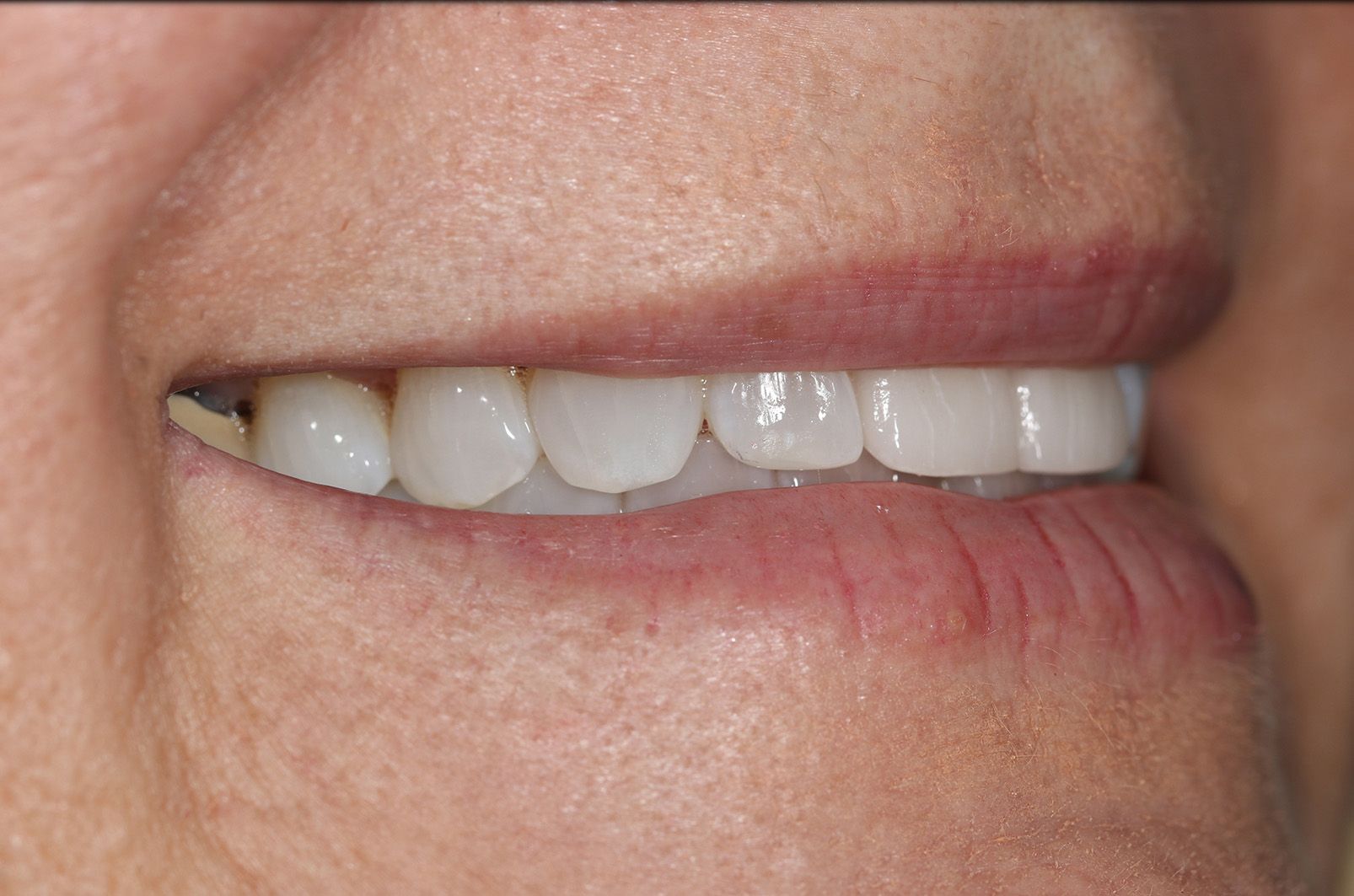 A close up of a woman 's smile with white teeth.