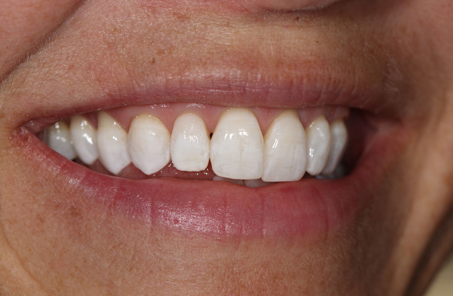 A close up of a woman 's smile with white teeth.