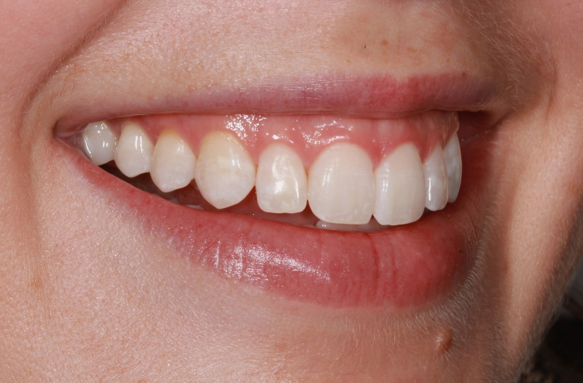 A close up of a woman 's smile with white teeth.