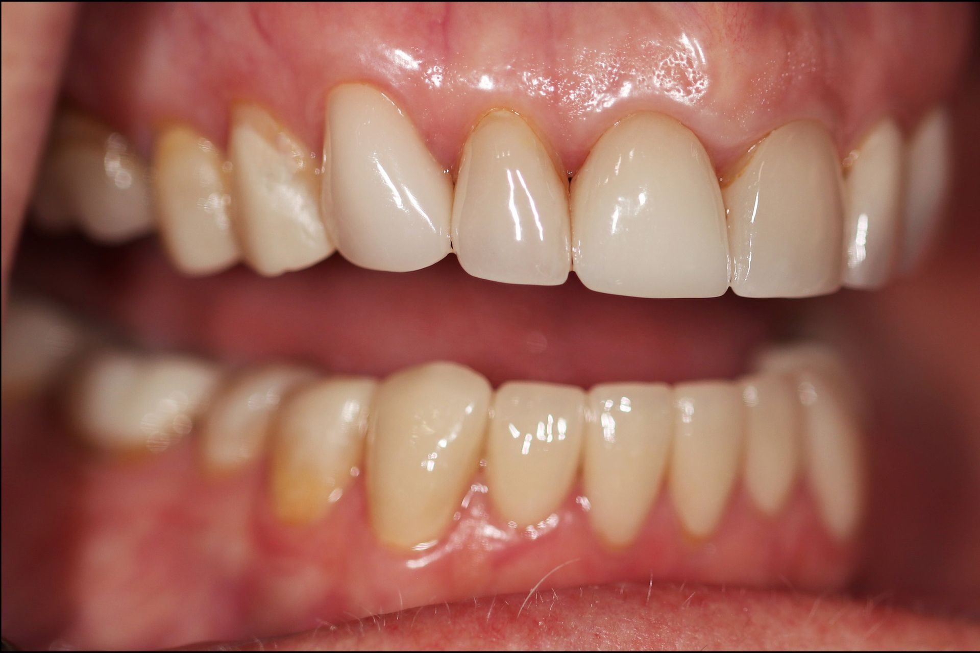 A close up of a person 's teeth with white teeth.