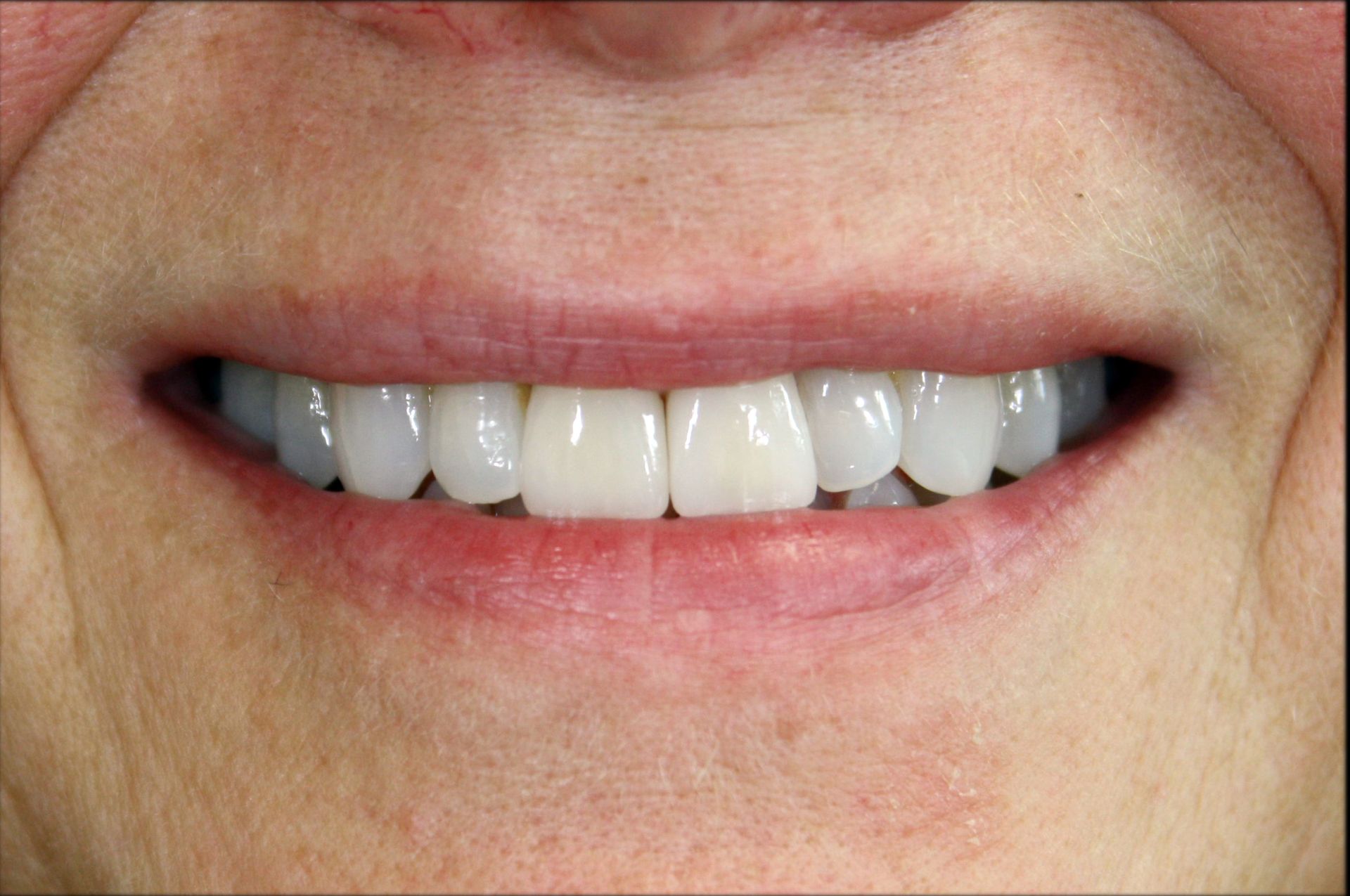 A close up of a woman 's smile with white teeth.