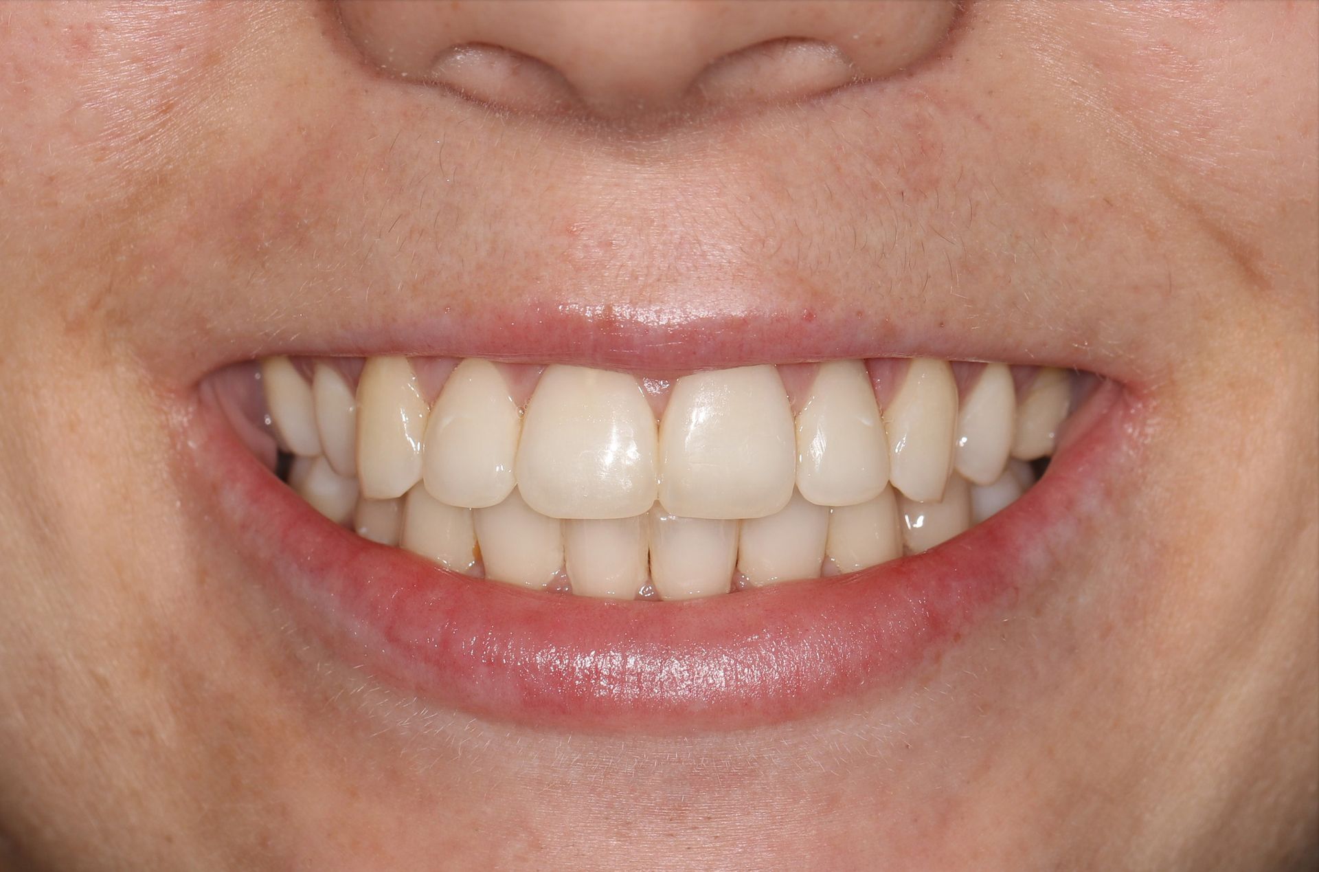 A close up of a woman 's smile with white teeth.