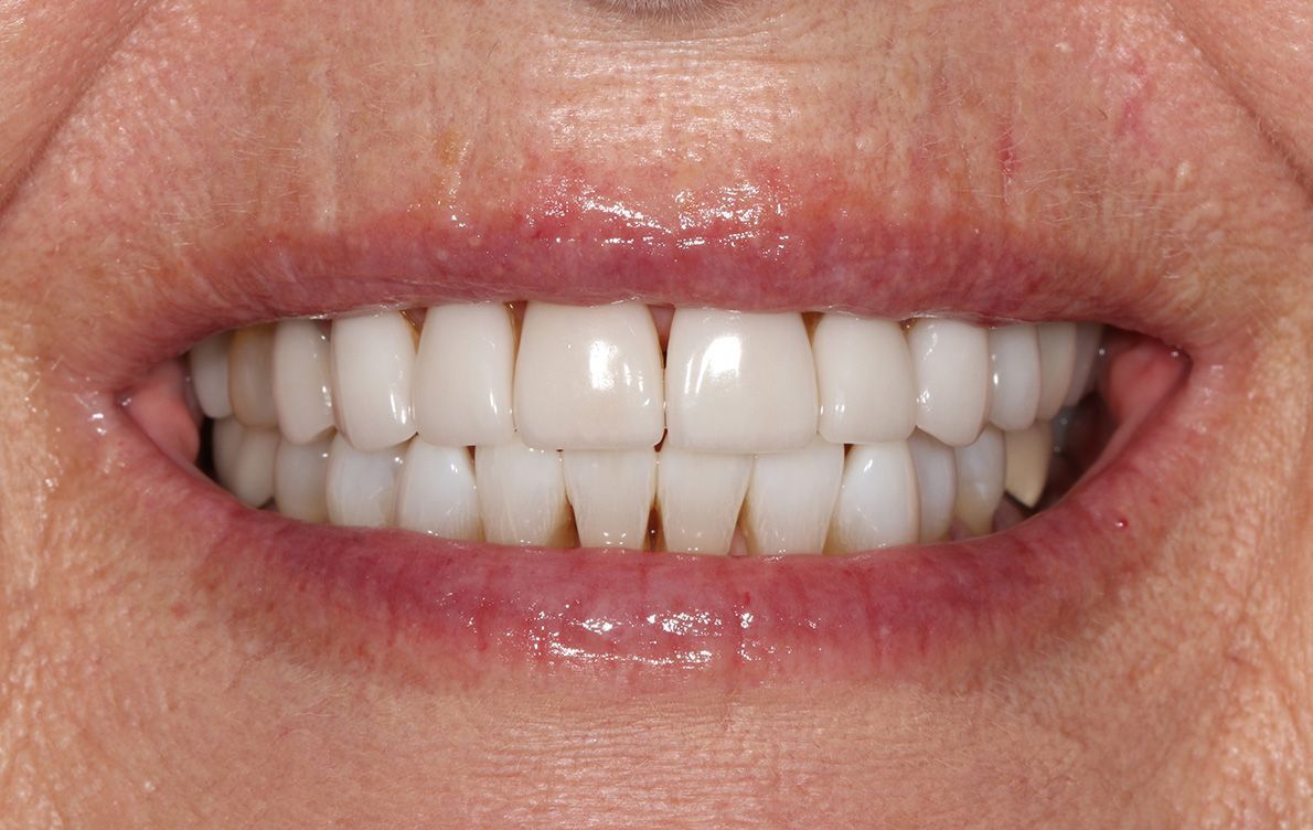 A close up of a woman 's mouth with white teeth.