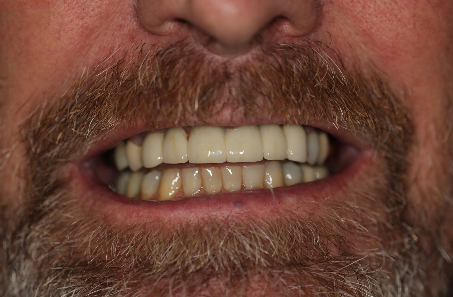 A close up of a man 's mouth with a beard and teeth.
