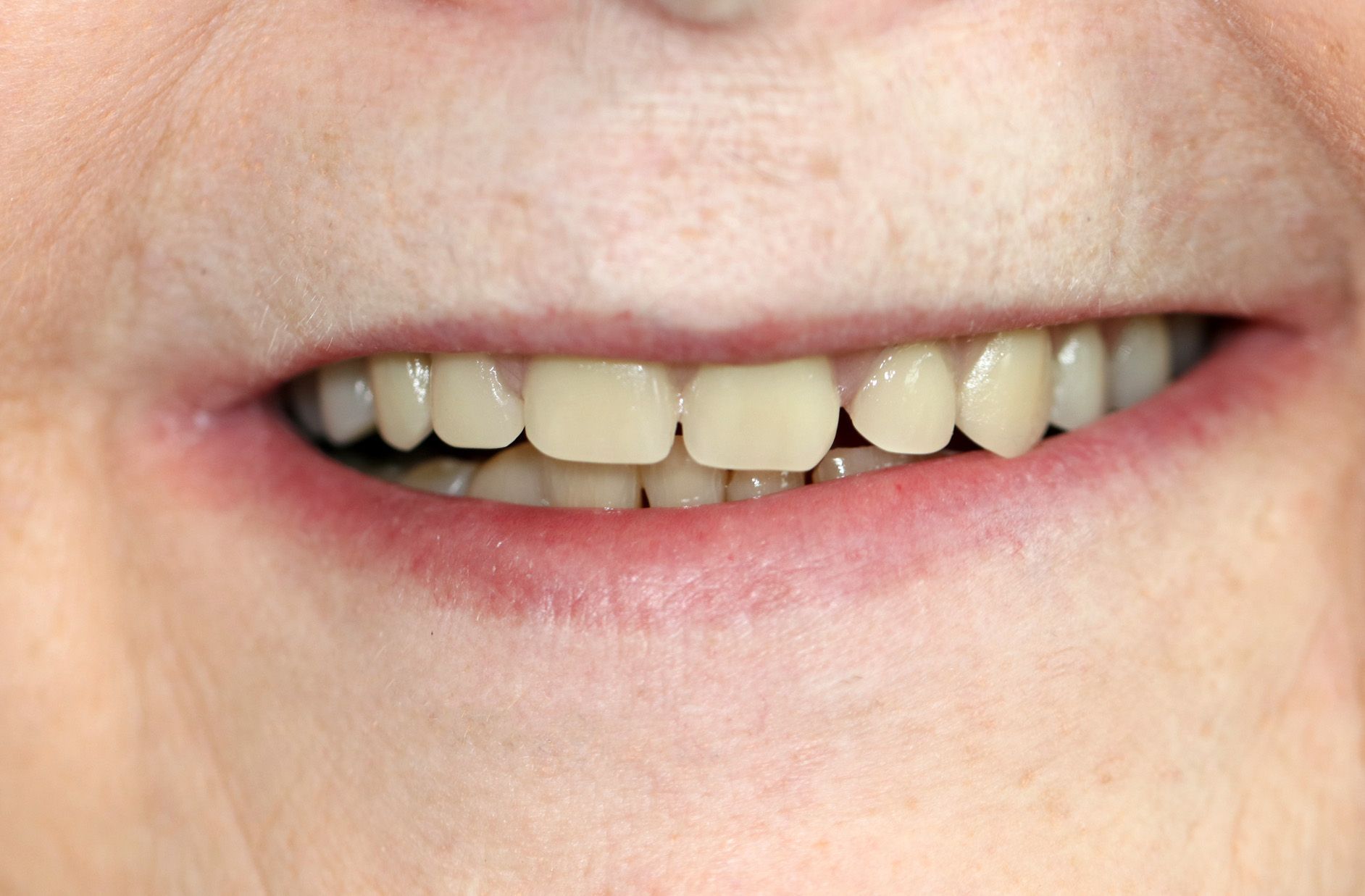 A close up of a woman 's smile with white teeth.