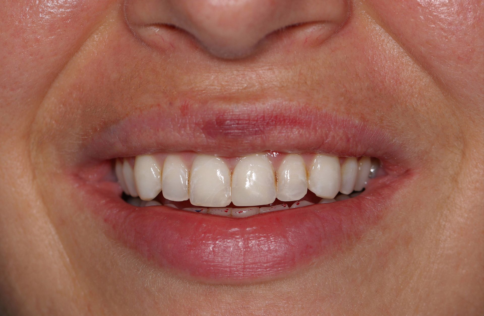 A close up of a woman 's mouth with white teeth.