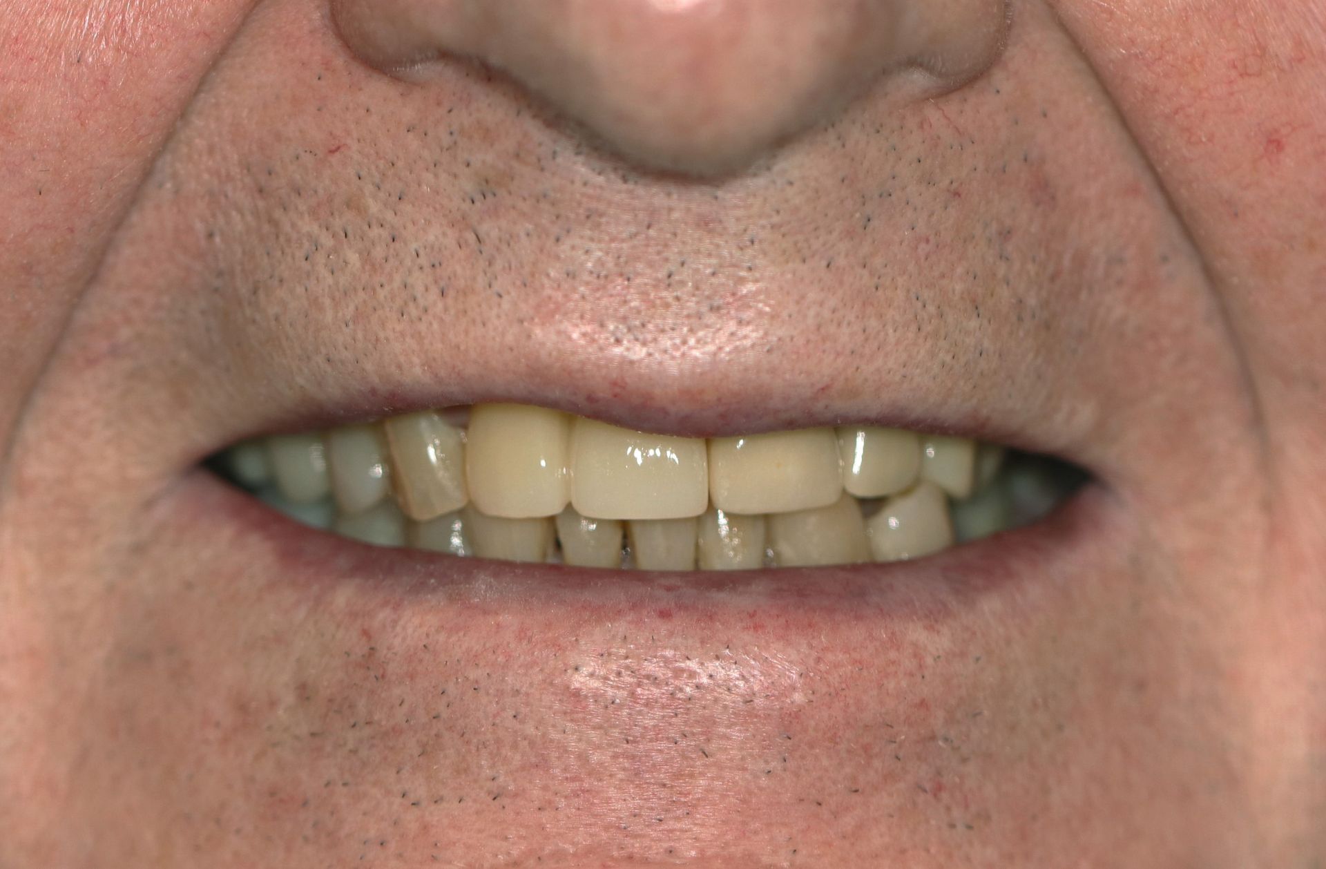 A close up of a man 's mouth with a missing tooth.