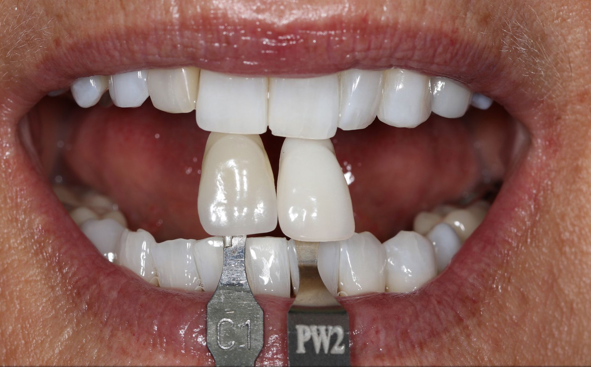 A close up of a person 's teeth with pw2 written on it
