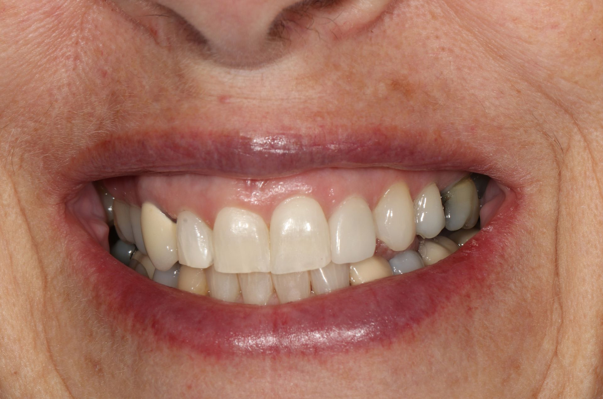 A close up of a woman 's smile with a broken tooth.