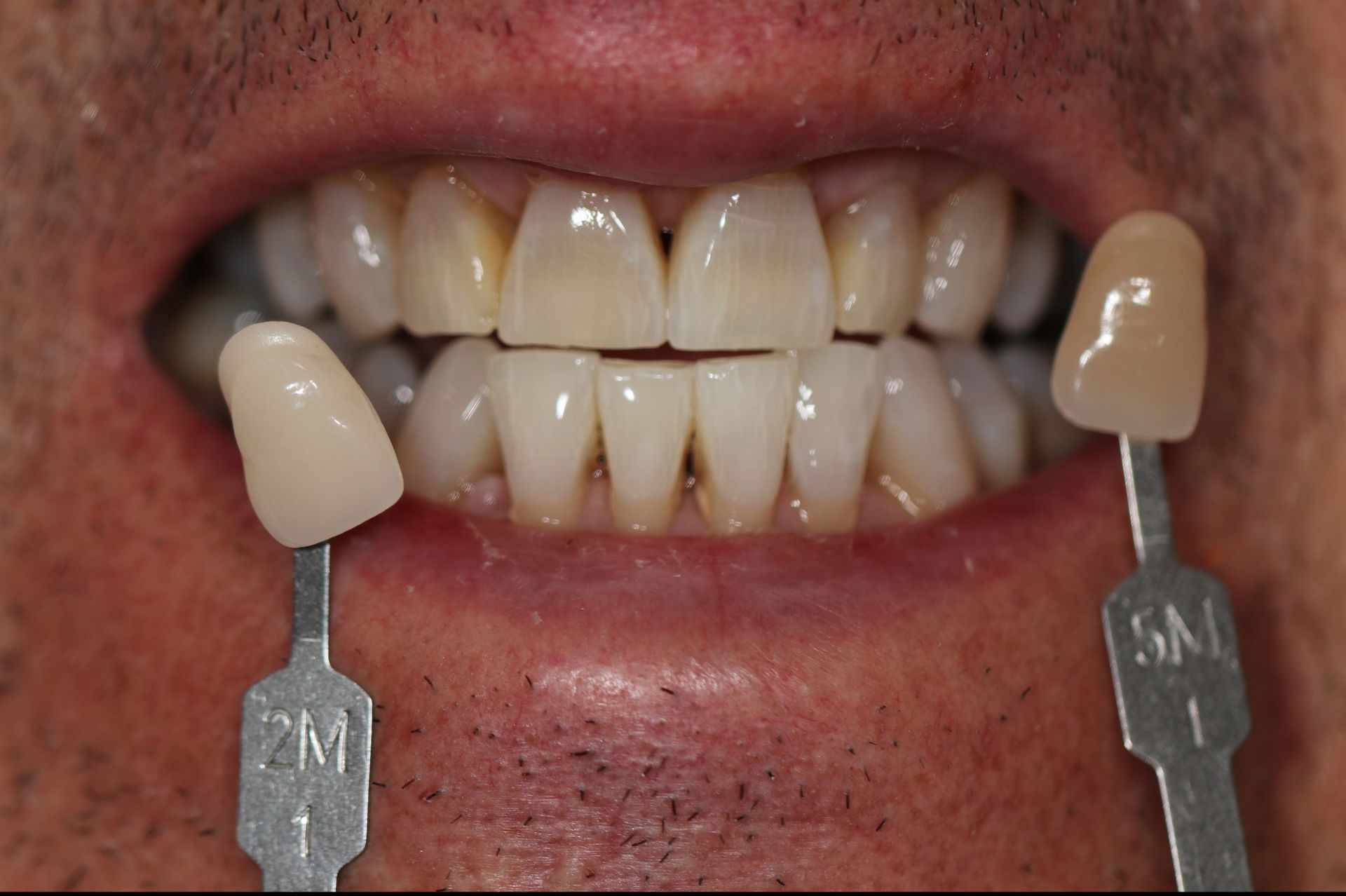 A close up of a man 's teeth with two tooth shades in his mouth.