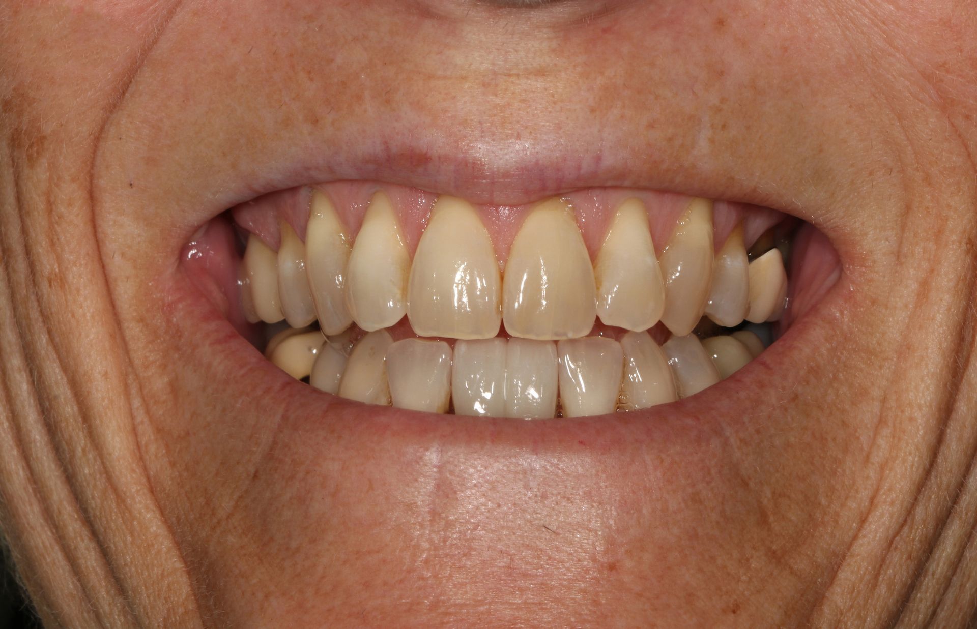 A close up of a person 's mouth with white teeth.