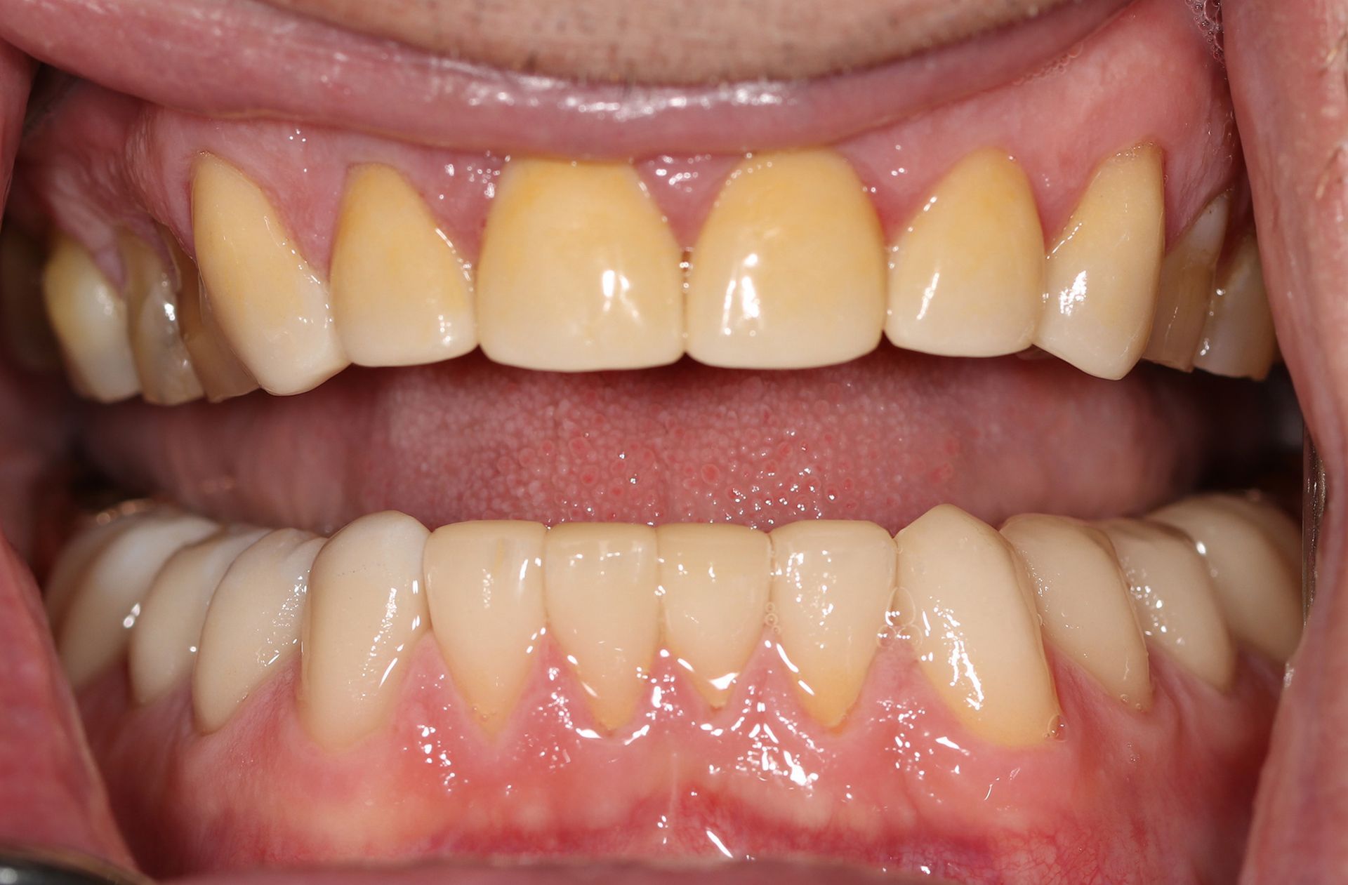 A close up of a person 's teeth with a dental bridge.