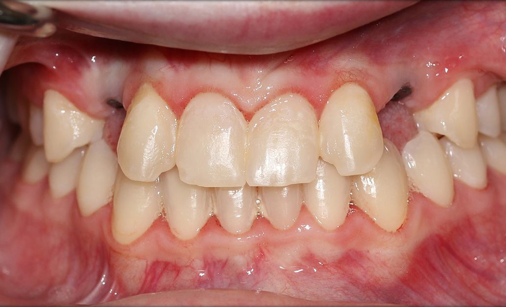 A close up of a person 's teeth and gums.