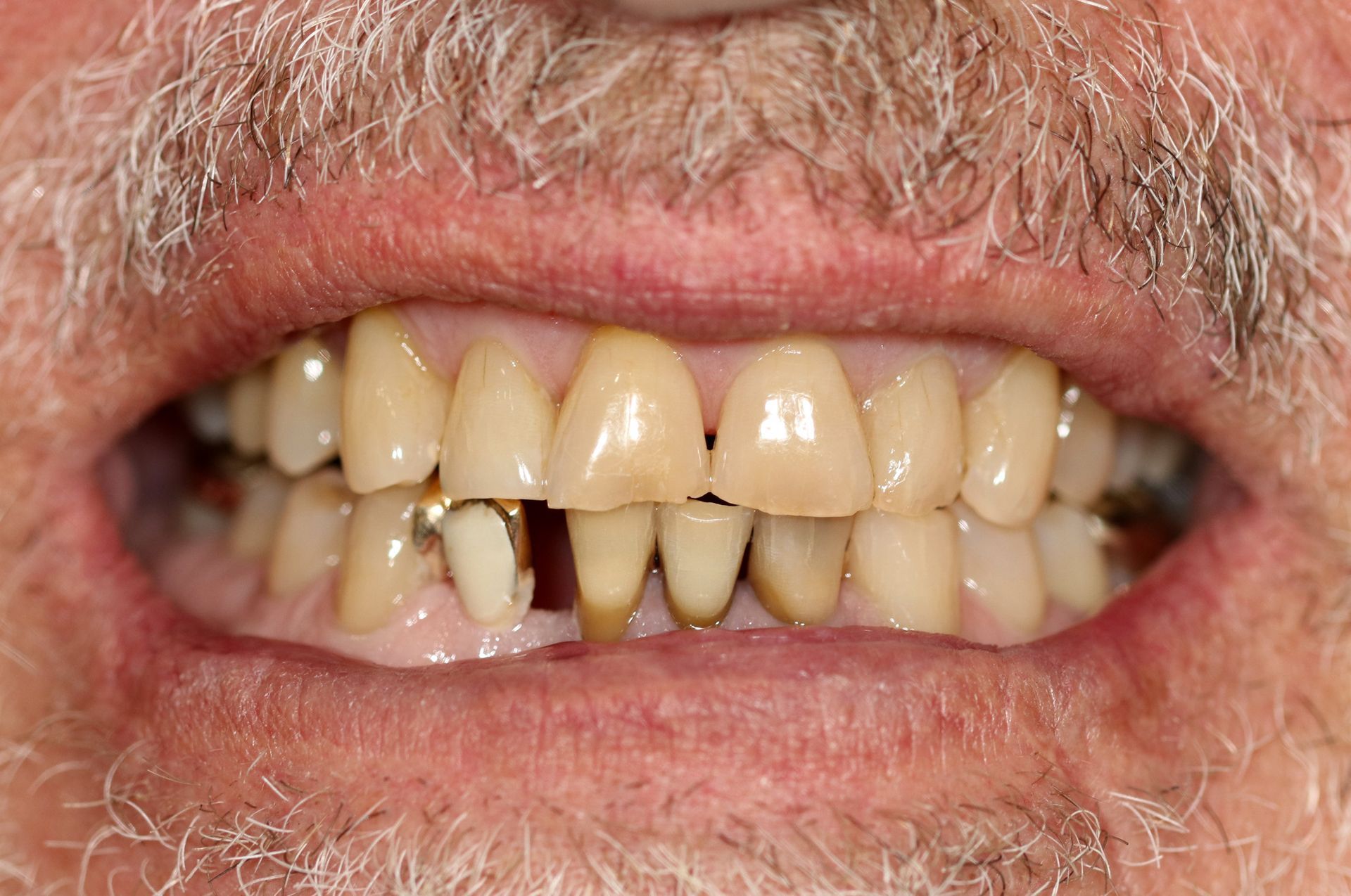 A close up of a man 's teeth with a beard.