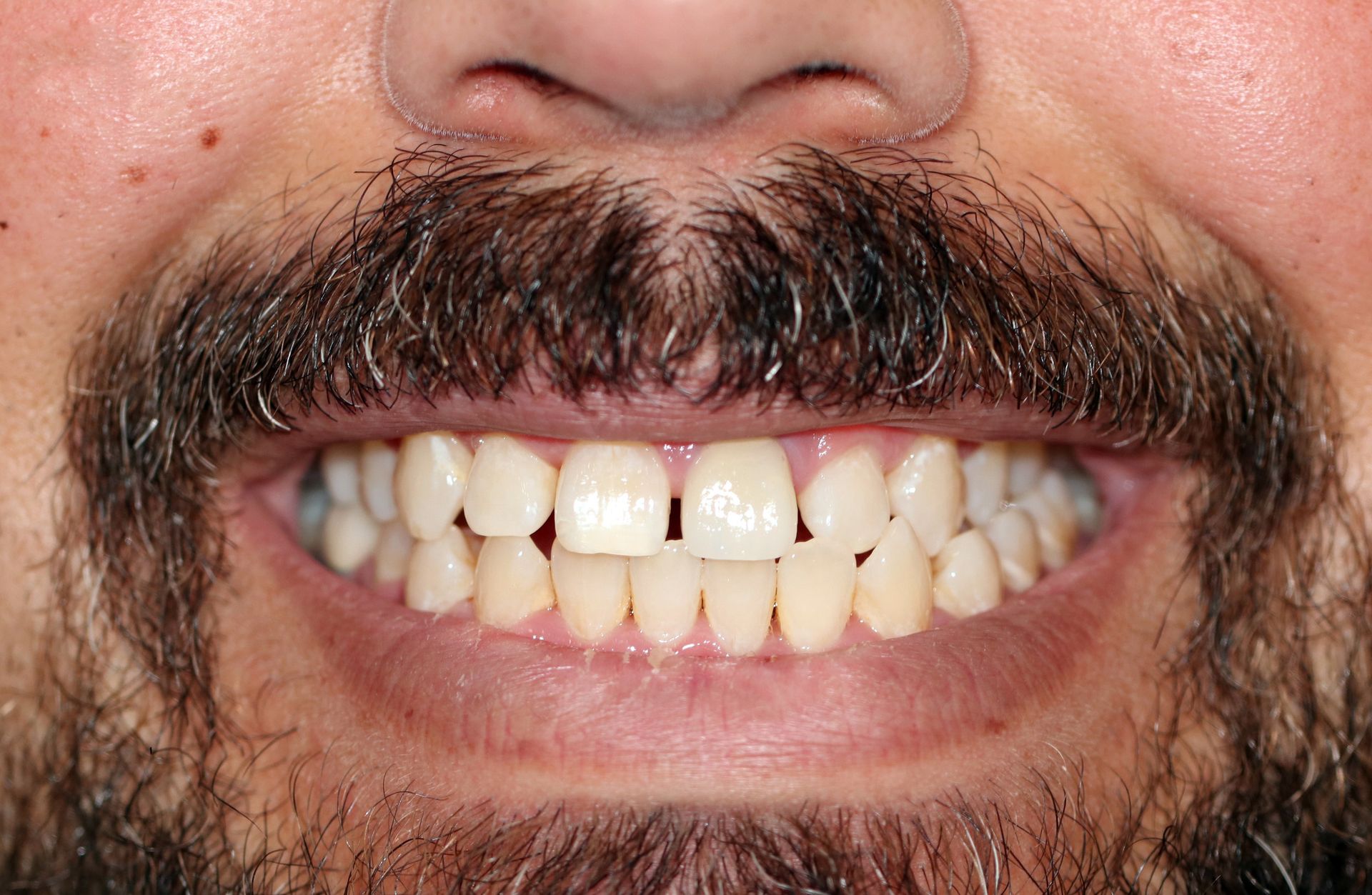 A close up of a man 's mouth with a beard and white teeth.
