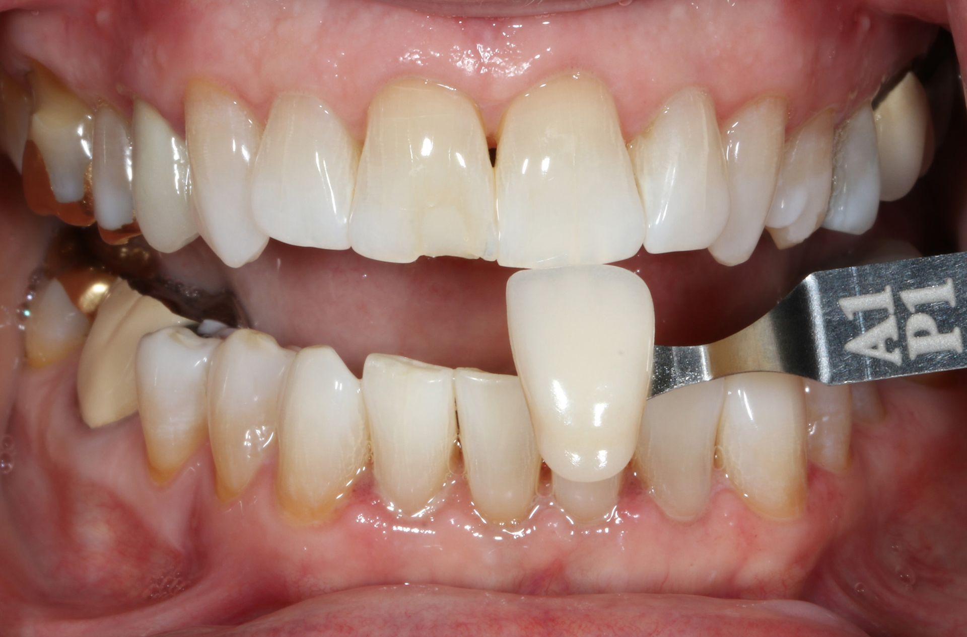 A close up of a person 's teeth with a white tooth in the middle.