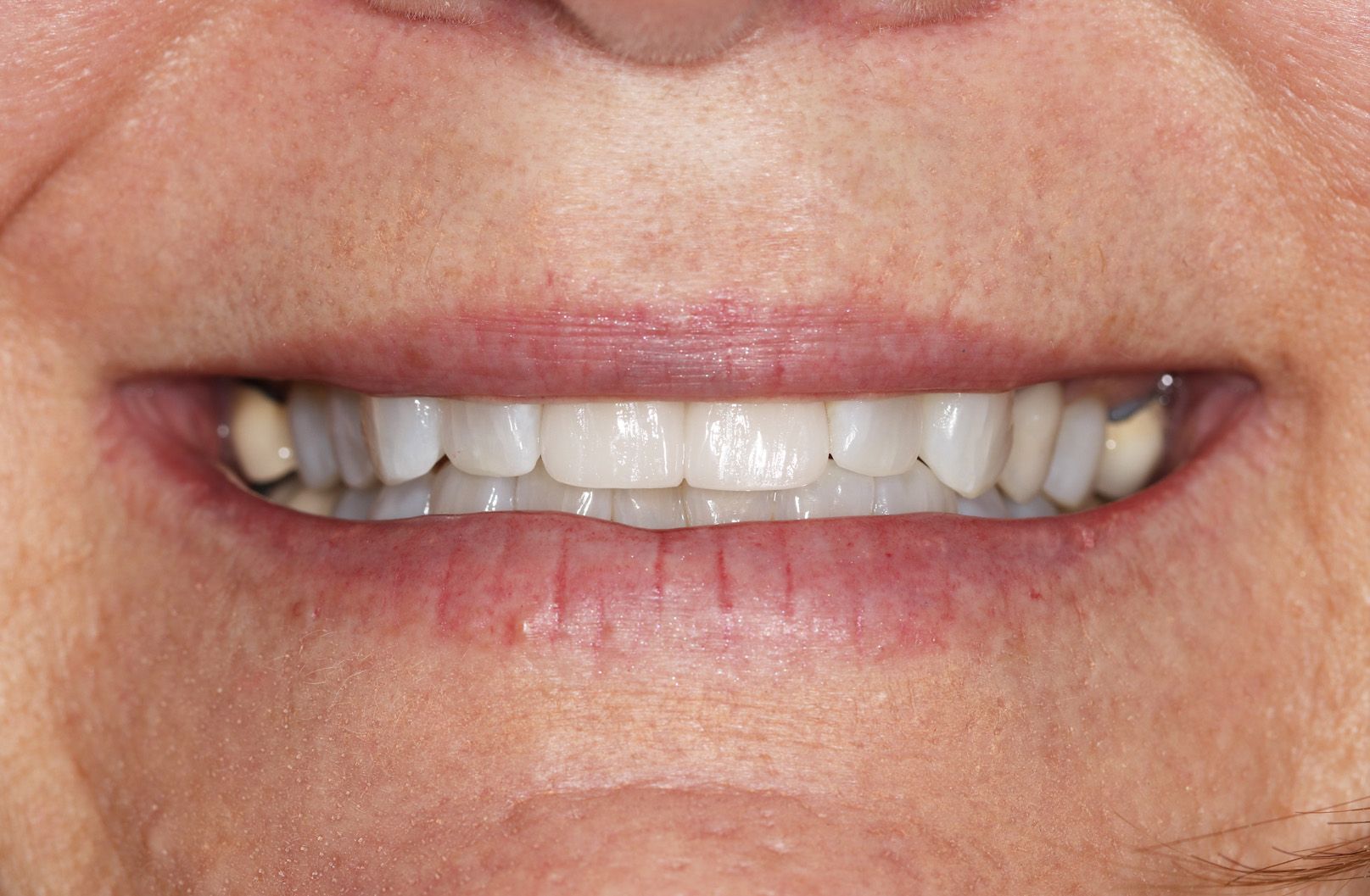 A close up of a woman 's smile with missing teeth.