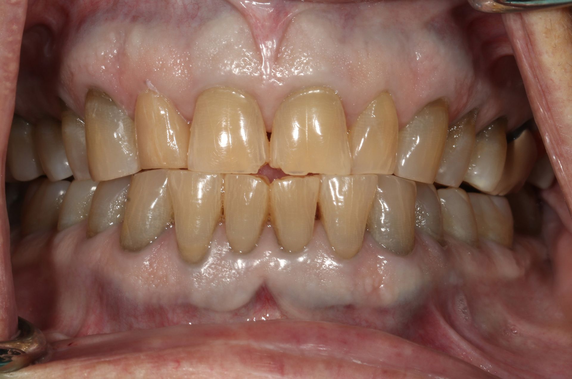 A close up of a person 's teeth with a hole in the middle.