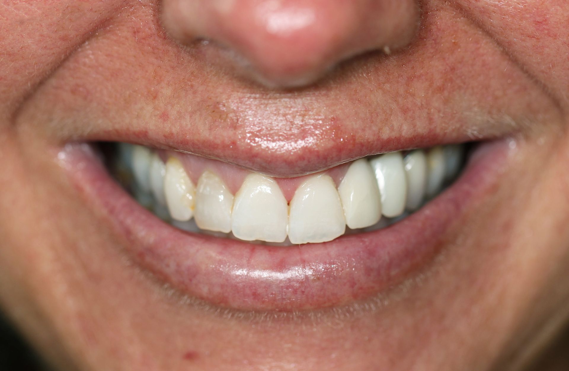 A close up of a woman 's smile with white teeth.