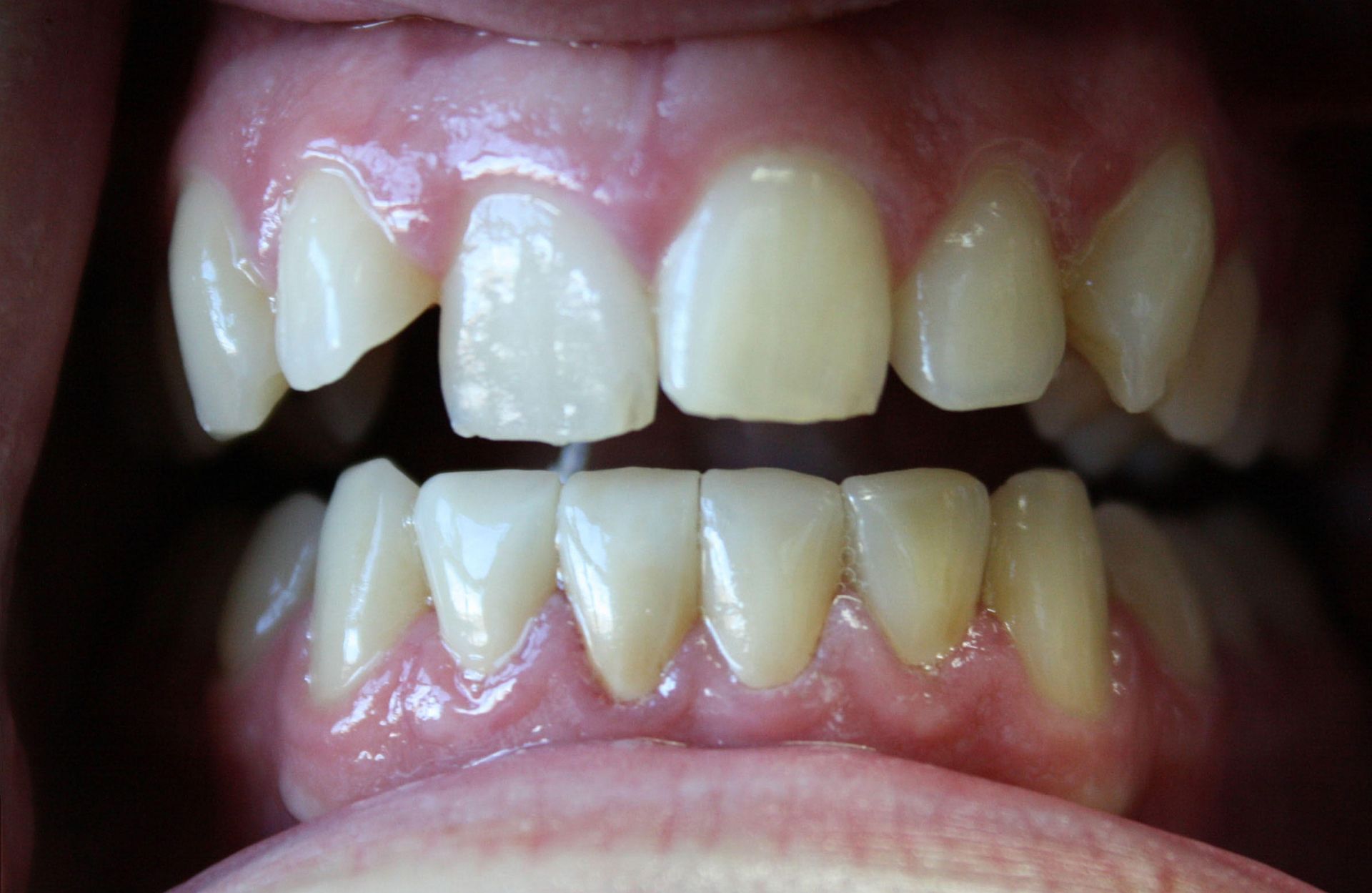 A close up of a person 's teeth with a broken tooth.